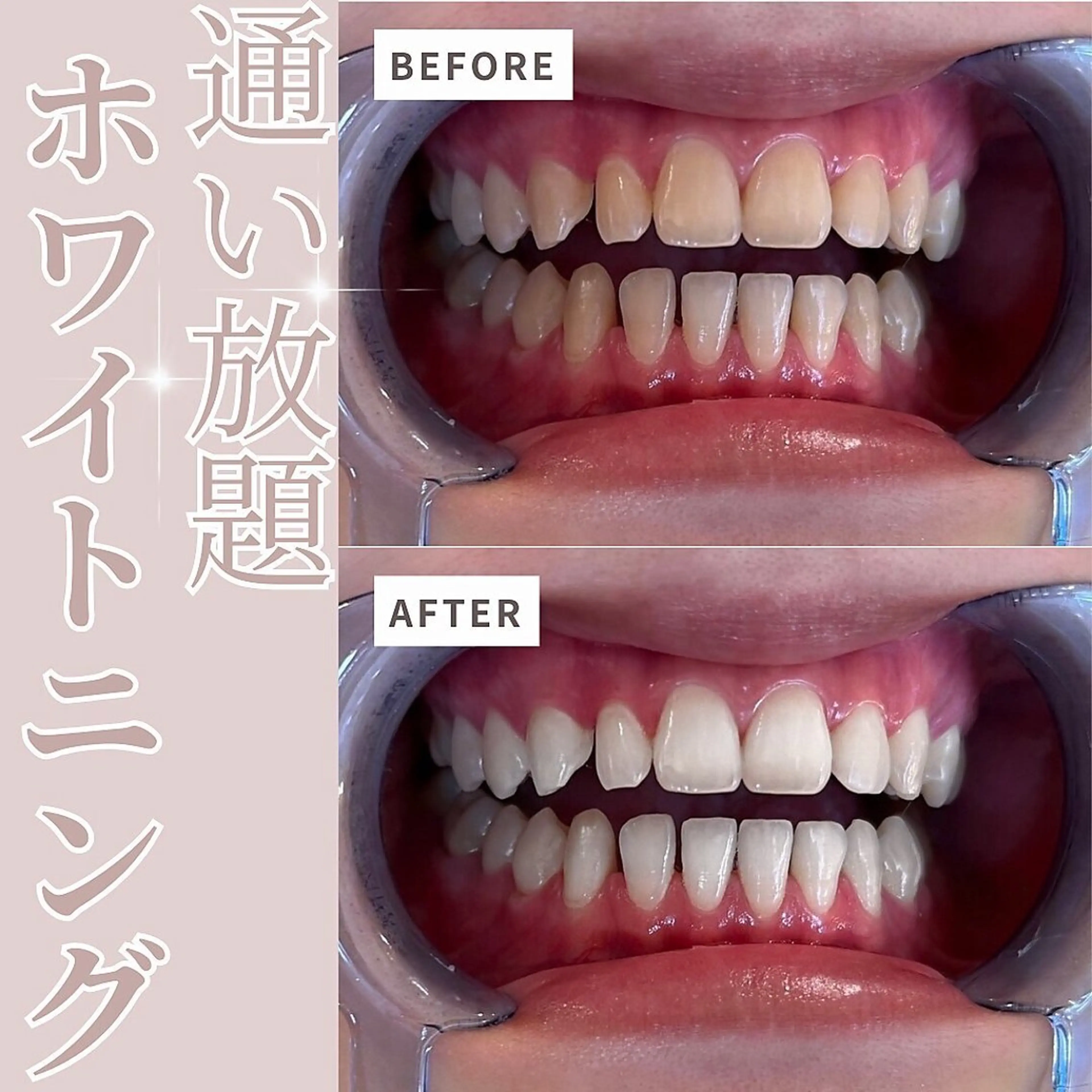 ecxia white 高田馬場所属・セルフホワイトニング エクシア 高田馬場のその他イメージ