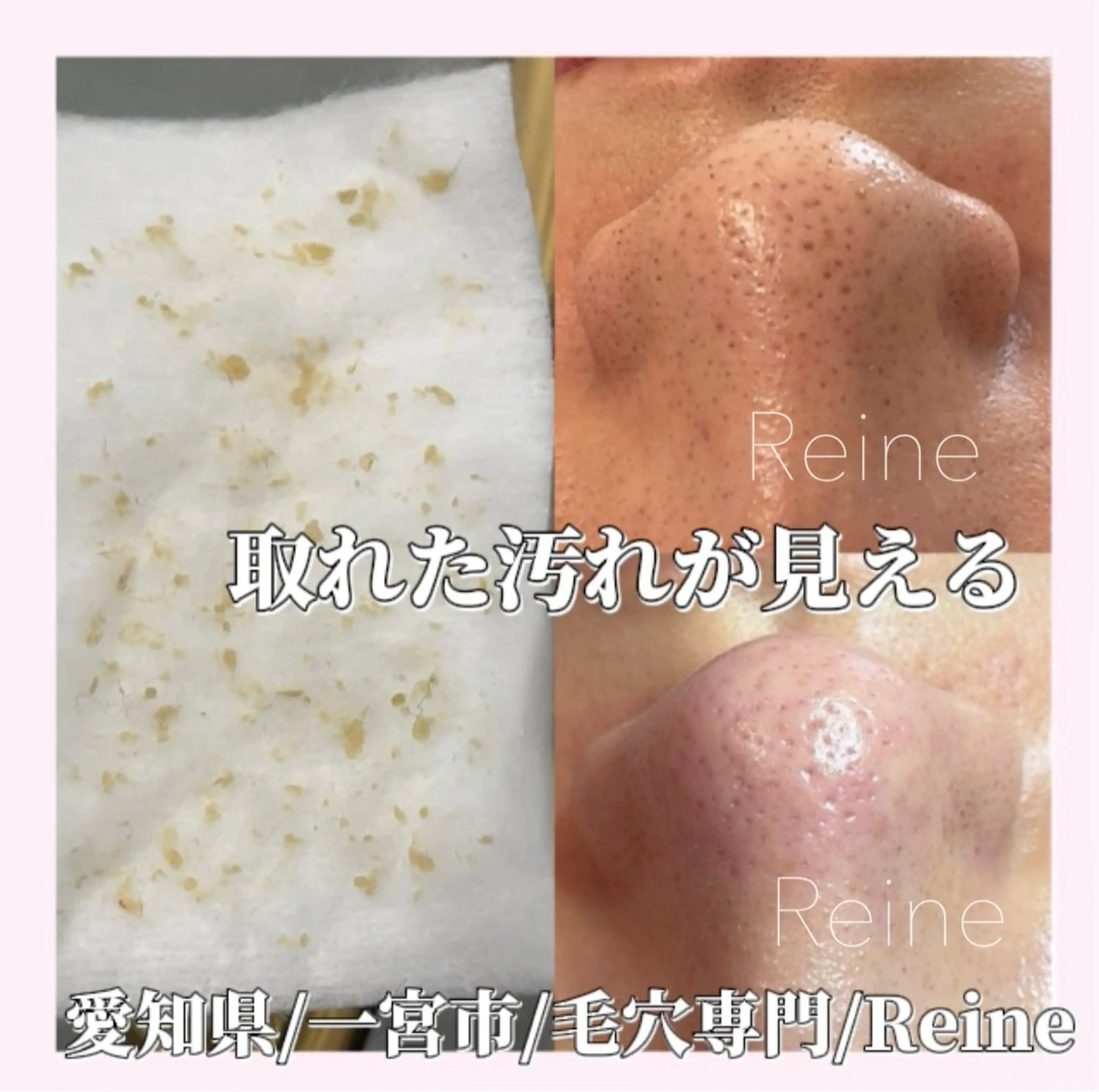 エステ Reine BeautySalon所属・毛穴/シミ肝斑/脱毛 横山梨里のエステ・リラクイメージ