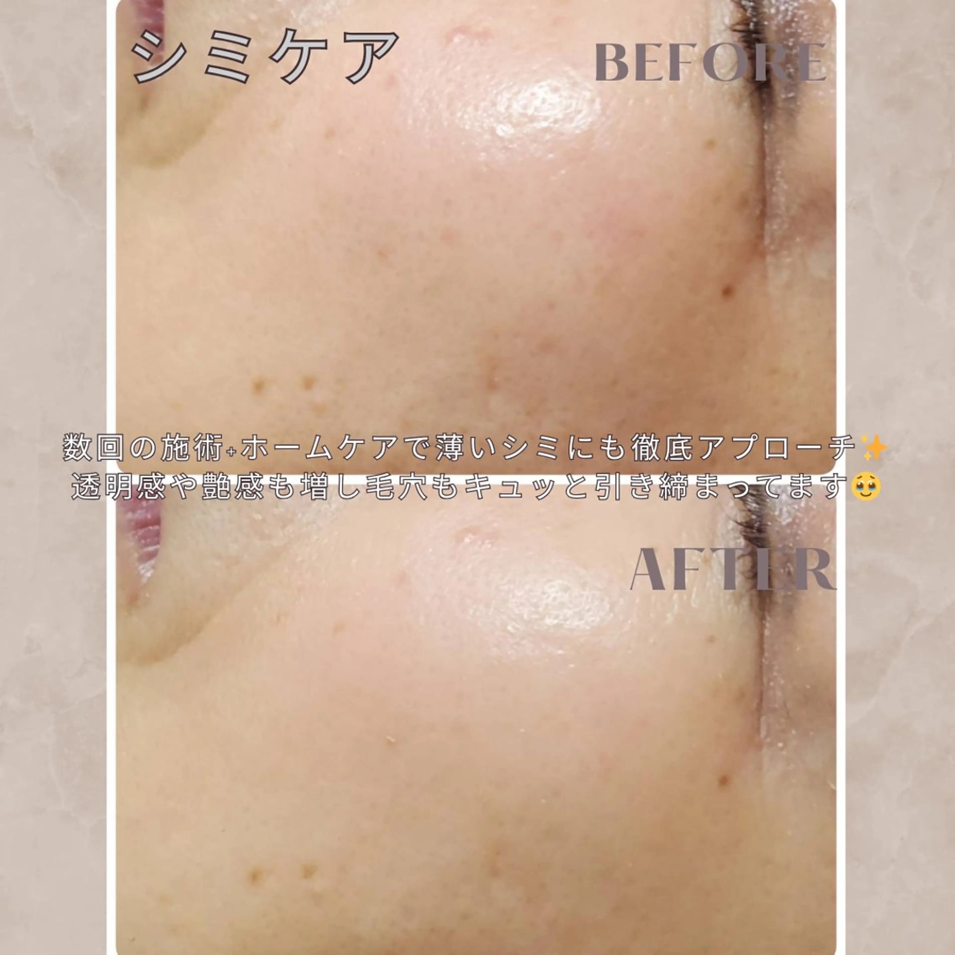 【モニター限定価格】毛穴ケア付き✨3回お試し幹細胞入りハーブピーリング残り2名様で終了🔥ダウンタイムなし✖️90分の写真