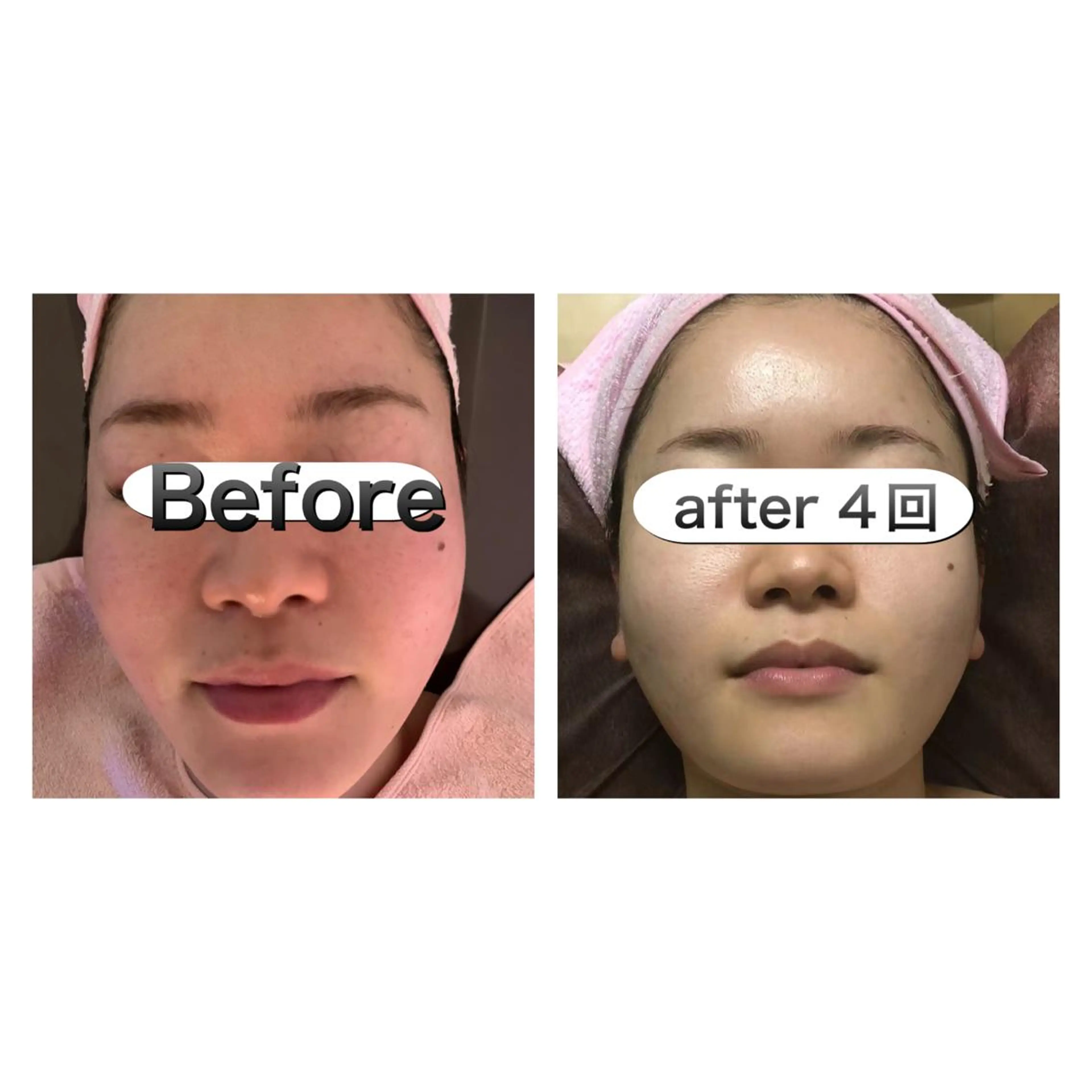 エステ 【ハイパーナイフ痩身&小顔コルギ&ハーブピーリング】K-Beauty　東新宿所属・kーbeauty小顔 コルギ&インディバのエステ・リラクイメージ
