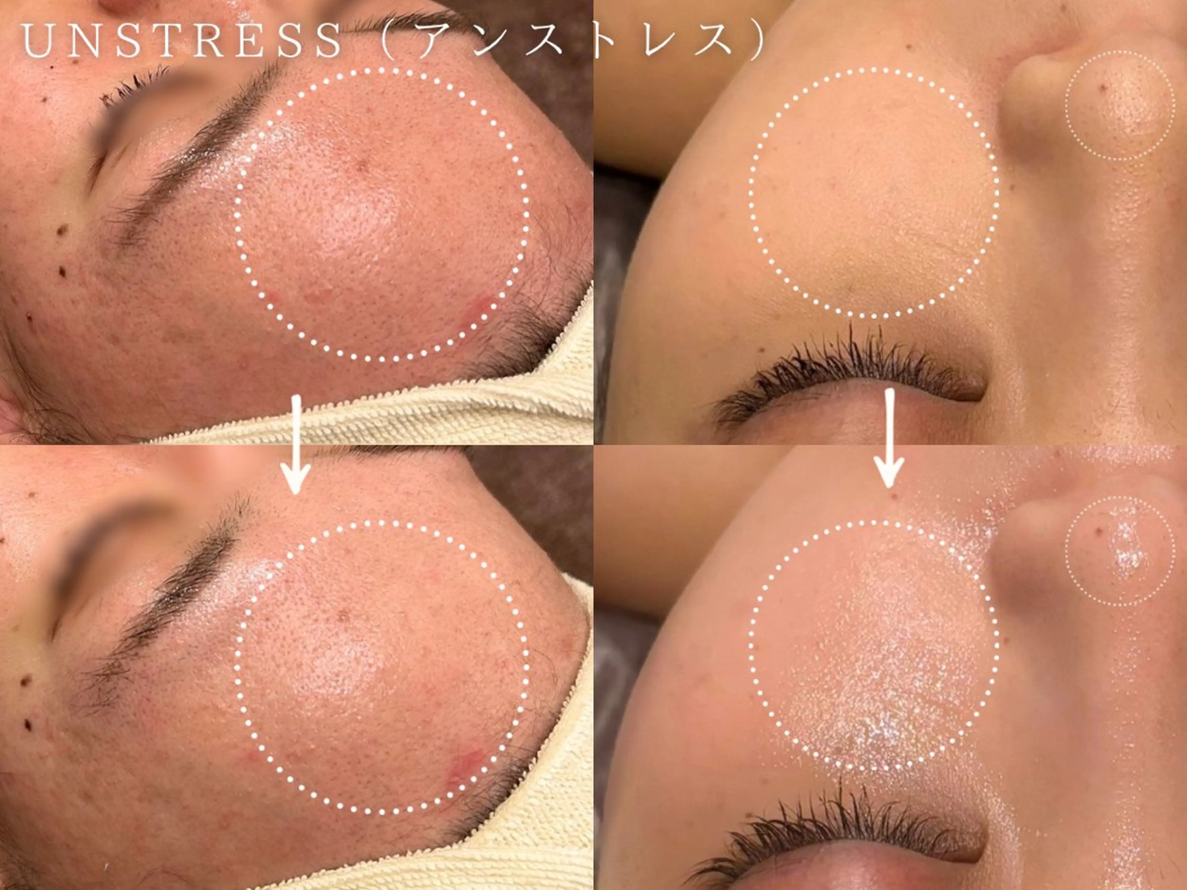 【20/21日限定3名様まで❣️】ダウンタイムなし！！肌質改善アンストレス乳酸菌ピーリング¥11,000の写真