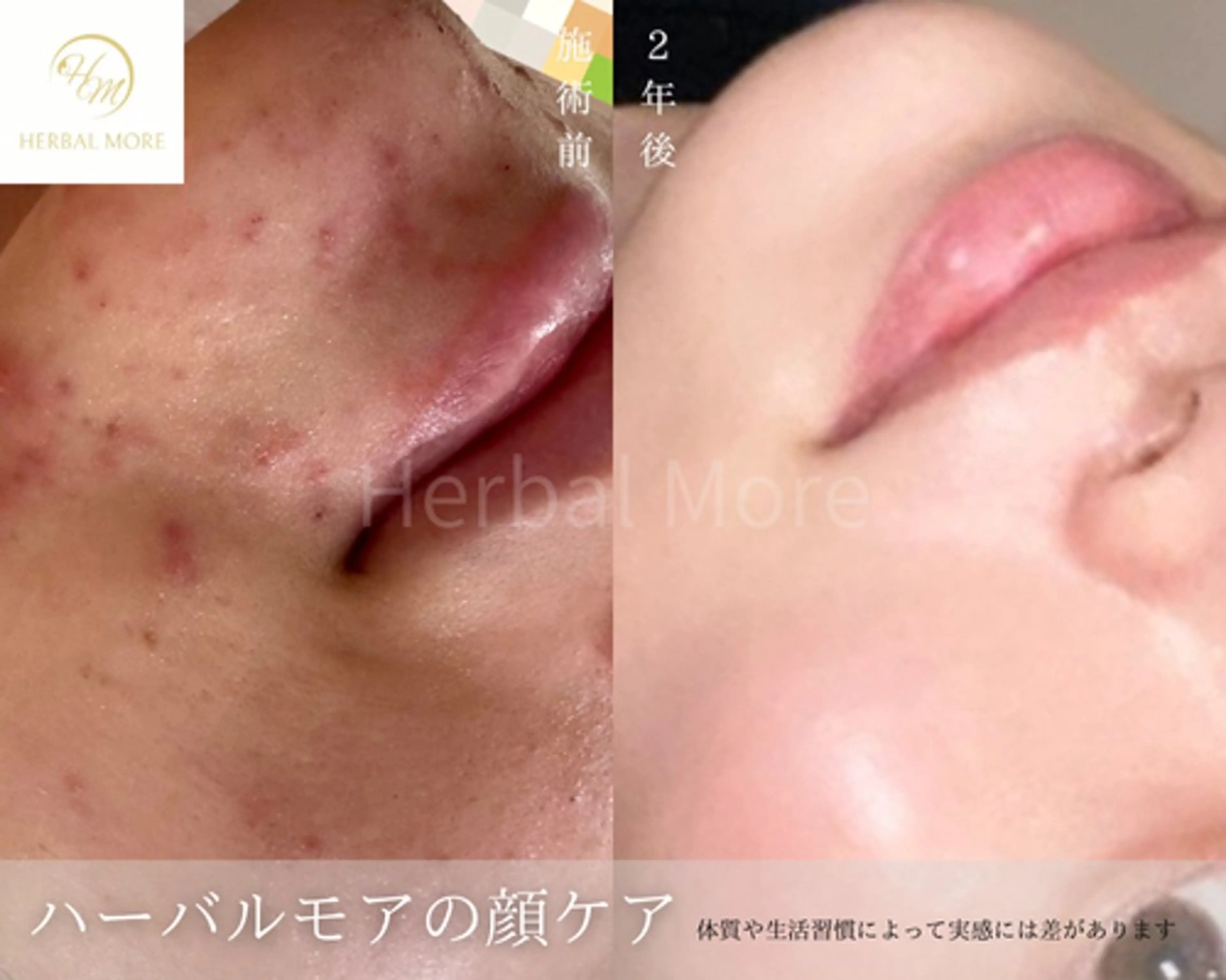 【顔◆人気No.1】剥けるハーブピーリング×鎮静パックの写真
