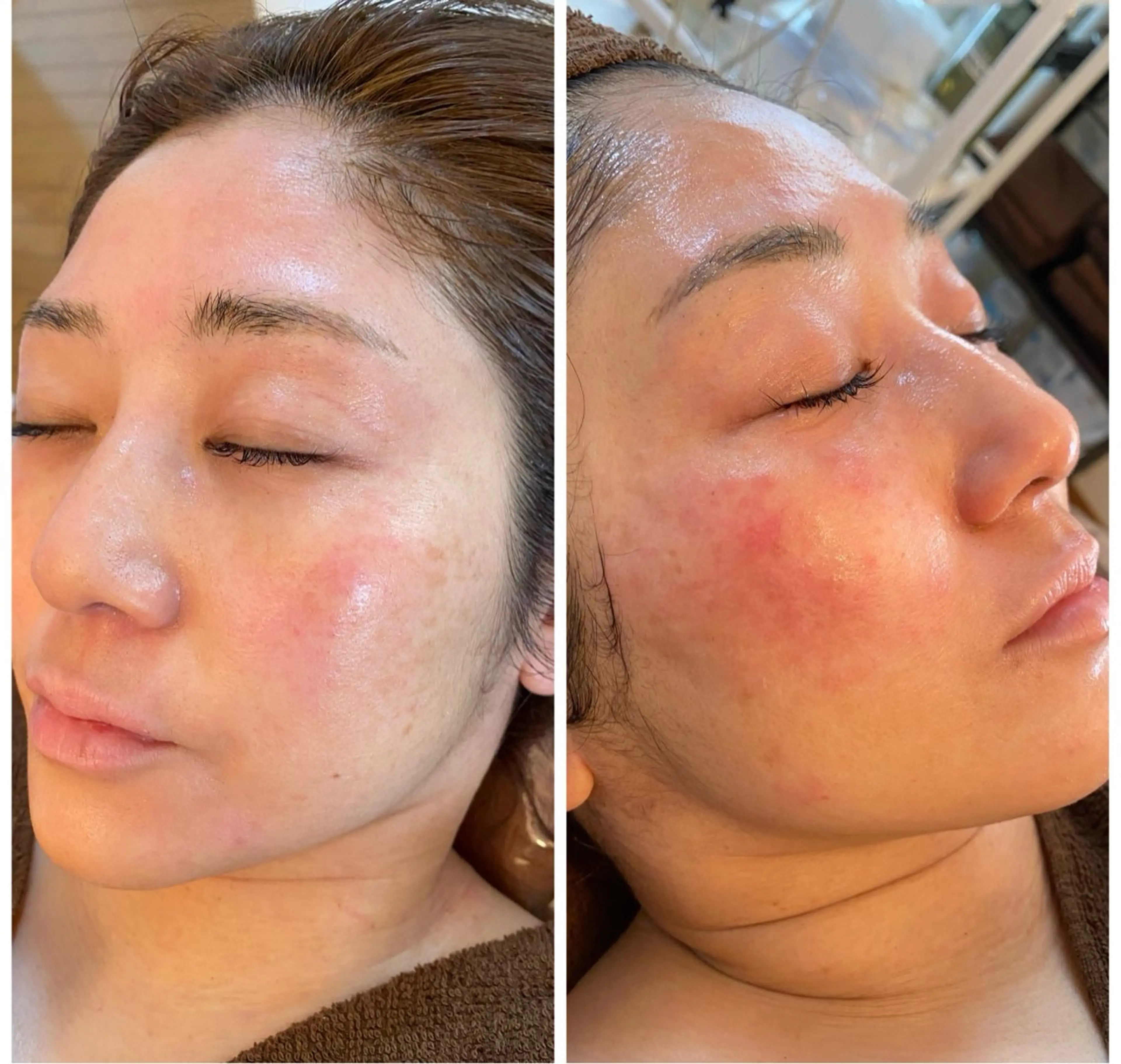 🌿estherヒト幹細胞ハーブピーリング🌿幹細胞とハーブの相乗効果で肌再生力UP🙌の写真