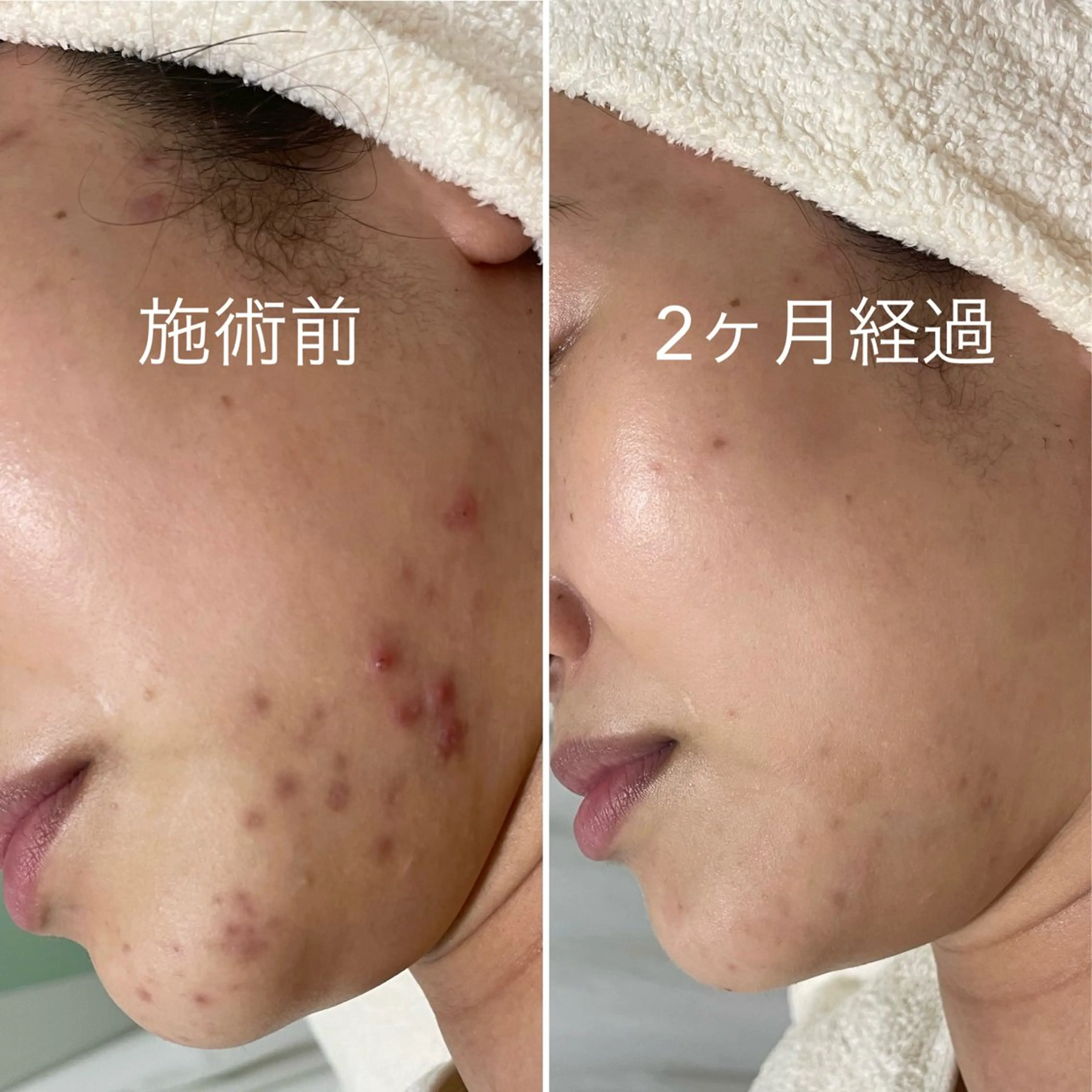 8月先着3名限定！✨口コミ価格 【ニキビケア卒業×再発防止】剥離なしでつるん肌へ！¥5980の写真