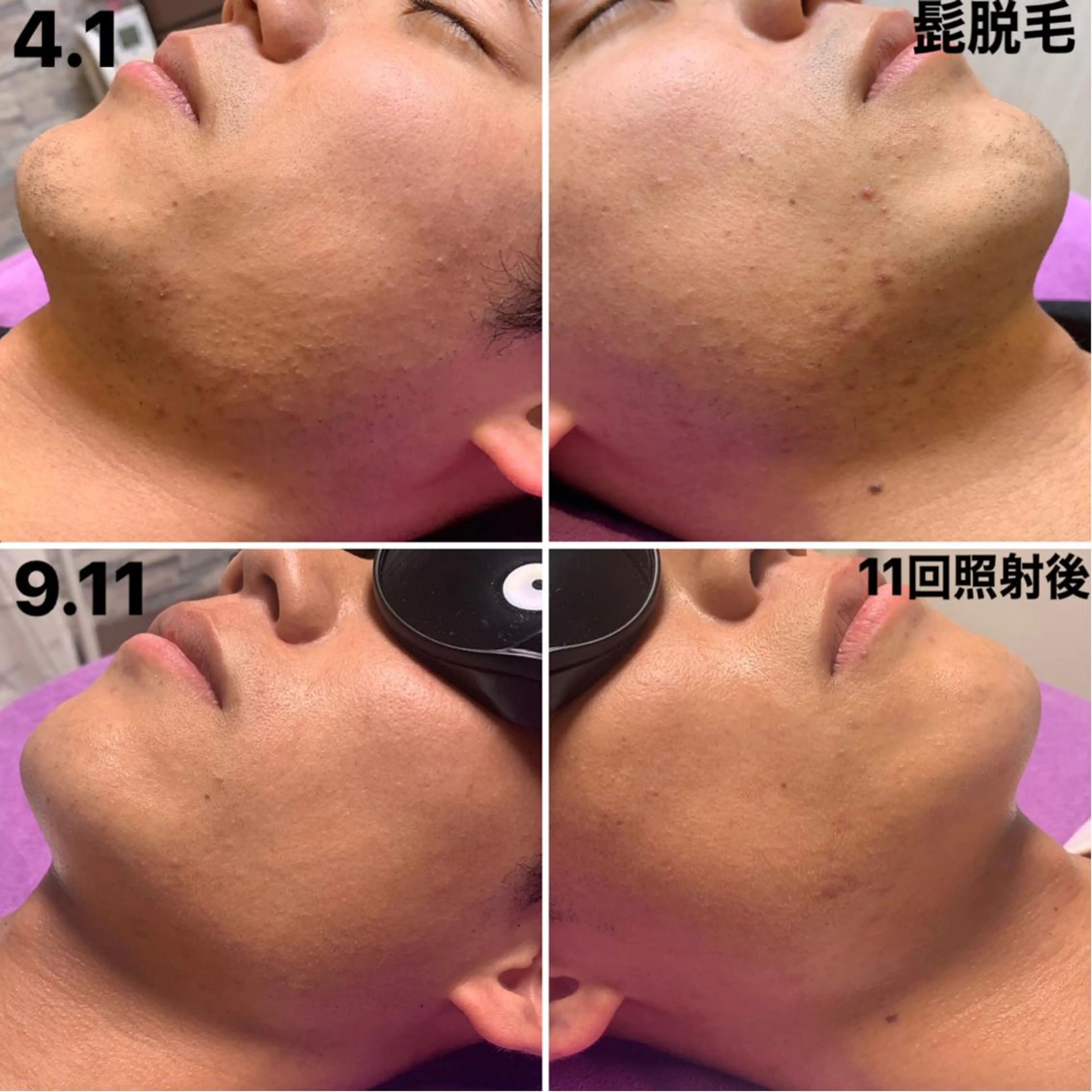 メンズ 脱毛＆エステサロン【アンリミット】所属・森谷 莉美のエステ・リラクイメージ