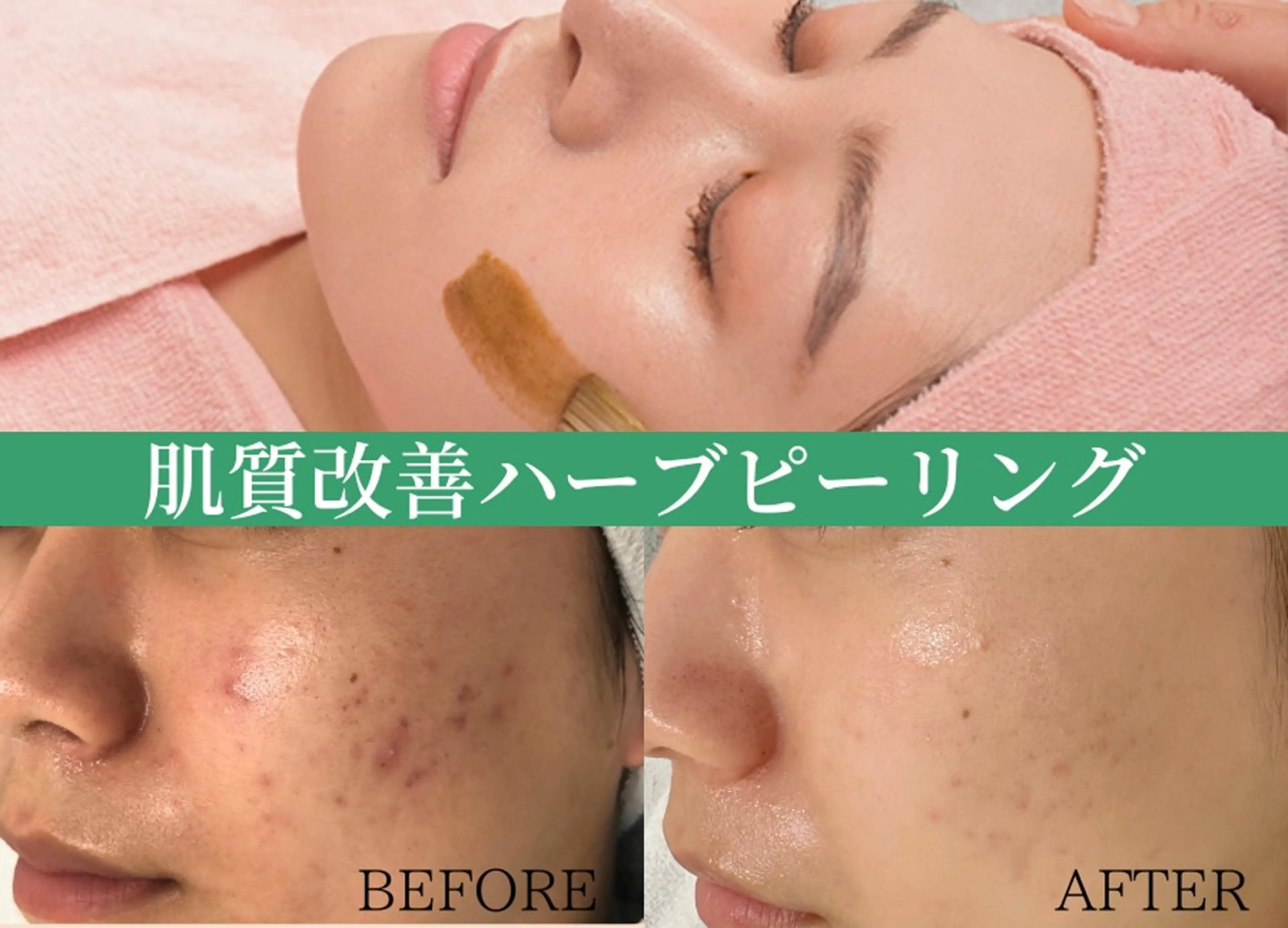 🌿《剥けないハーブピーリング》ダウンタイムなし！痛みなし！当日メイクOK！の写真