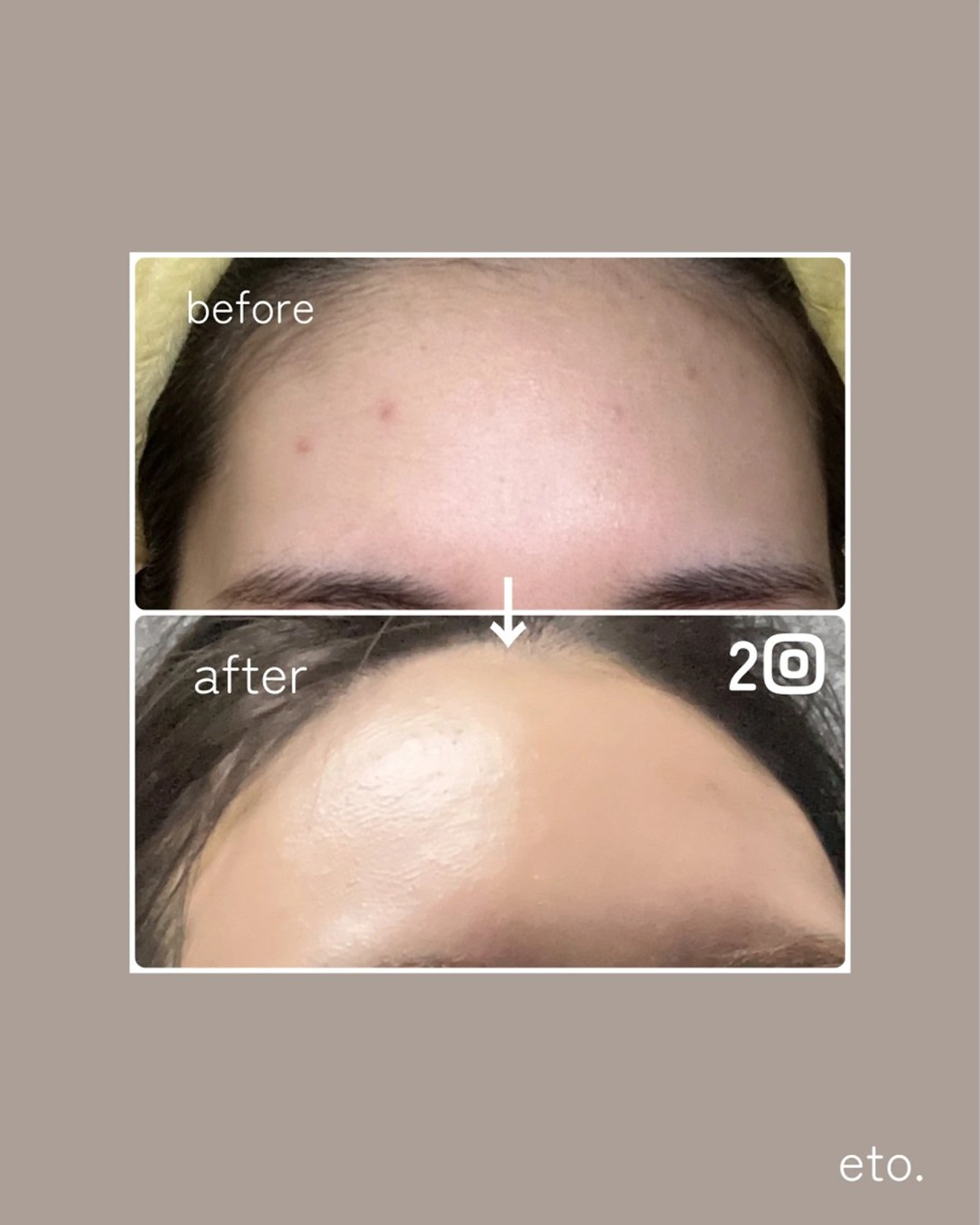 エステ eto.所属・肌質改善サロンeto ニキビ・ニキビ跡のエステ・リラクイメージ