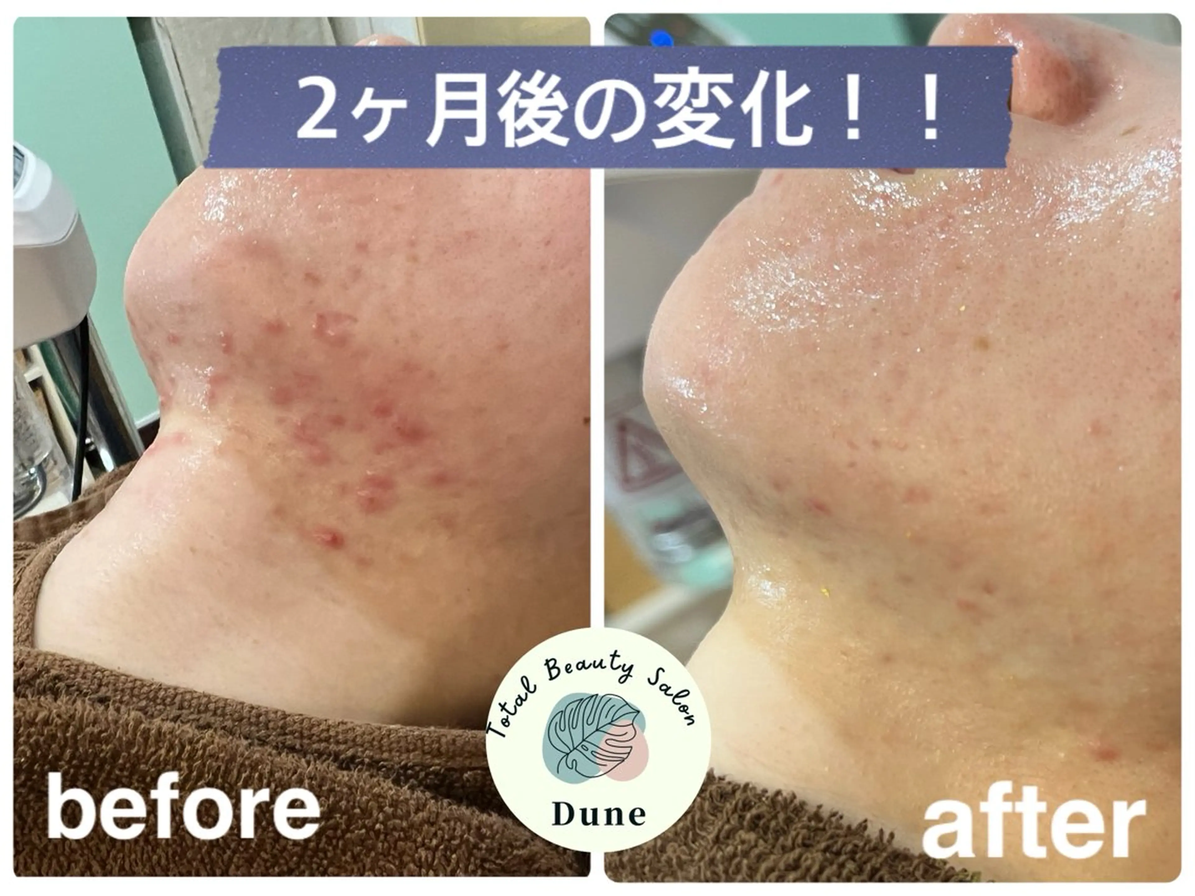 エステ Total beauty salon Dune所属・ニキビ・肌質改善 サロンDuneのエステ・リラクイメージ