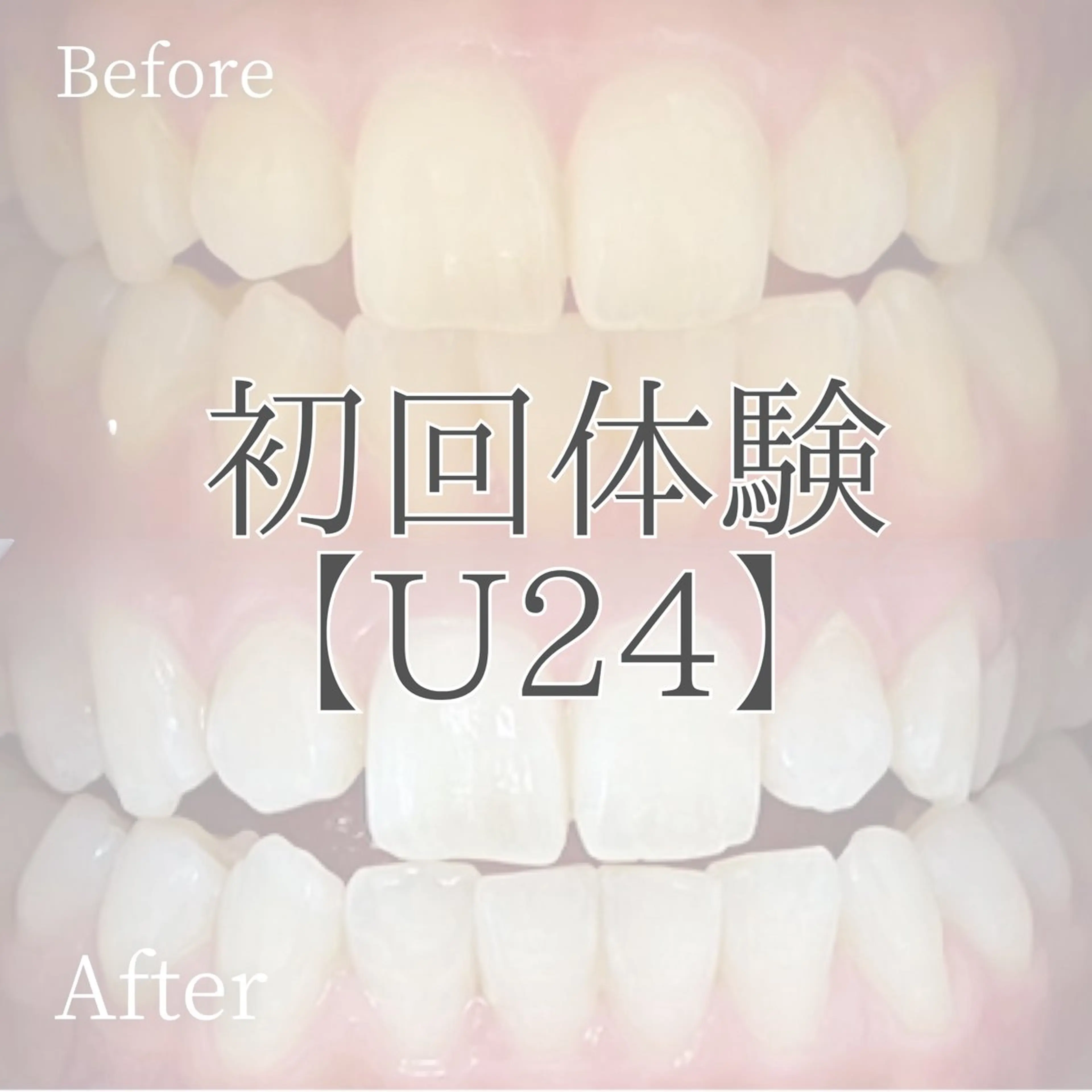 【ミニモ学割ホワイトニング🦷✨】おためし¥1,800✨2回目以降もコスパがいいからホワイトニング始めやすいです😊の写真