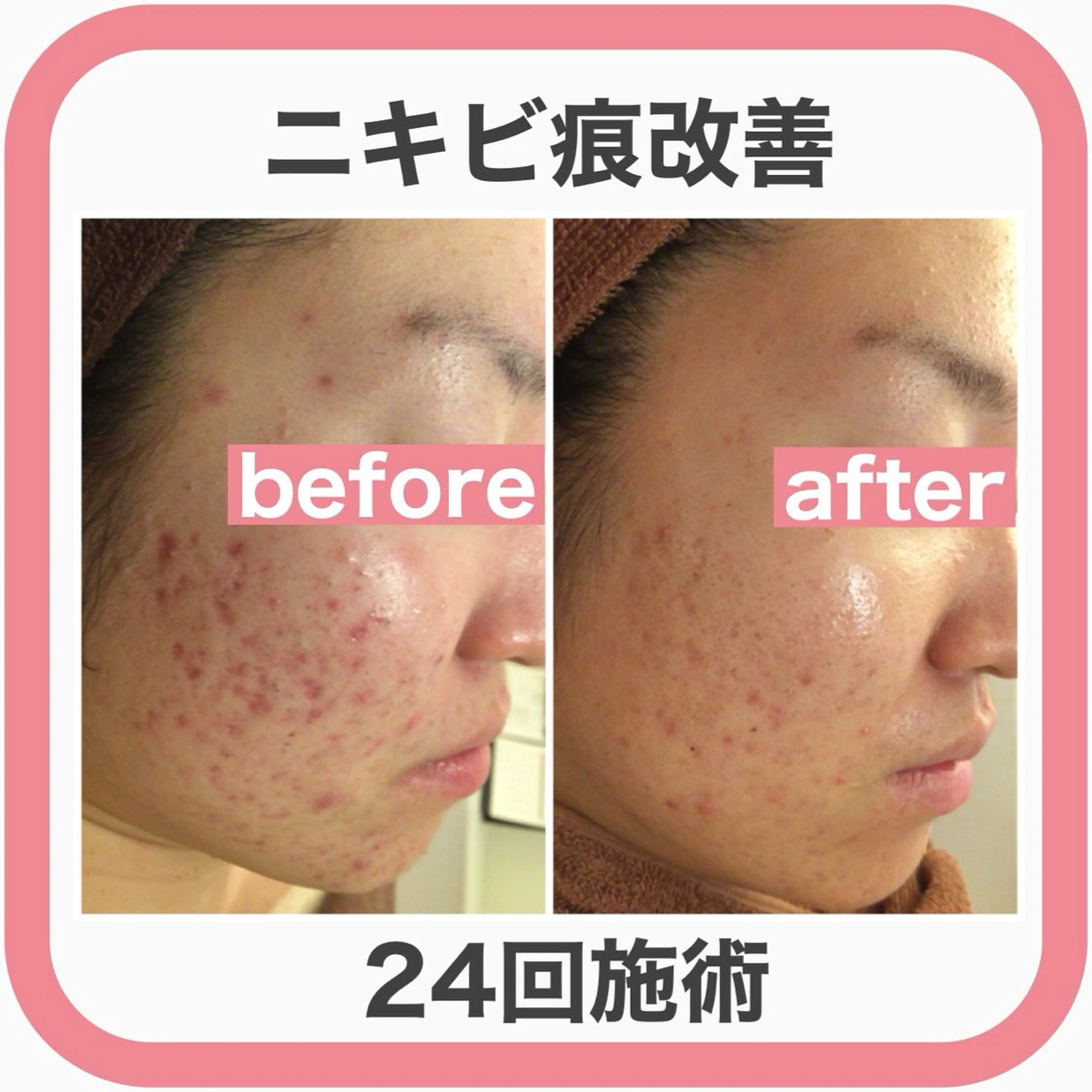 学生ニキビ改善🍀 優しい肌質改善のエステ・リラクイメージ