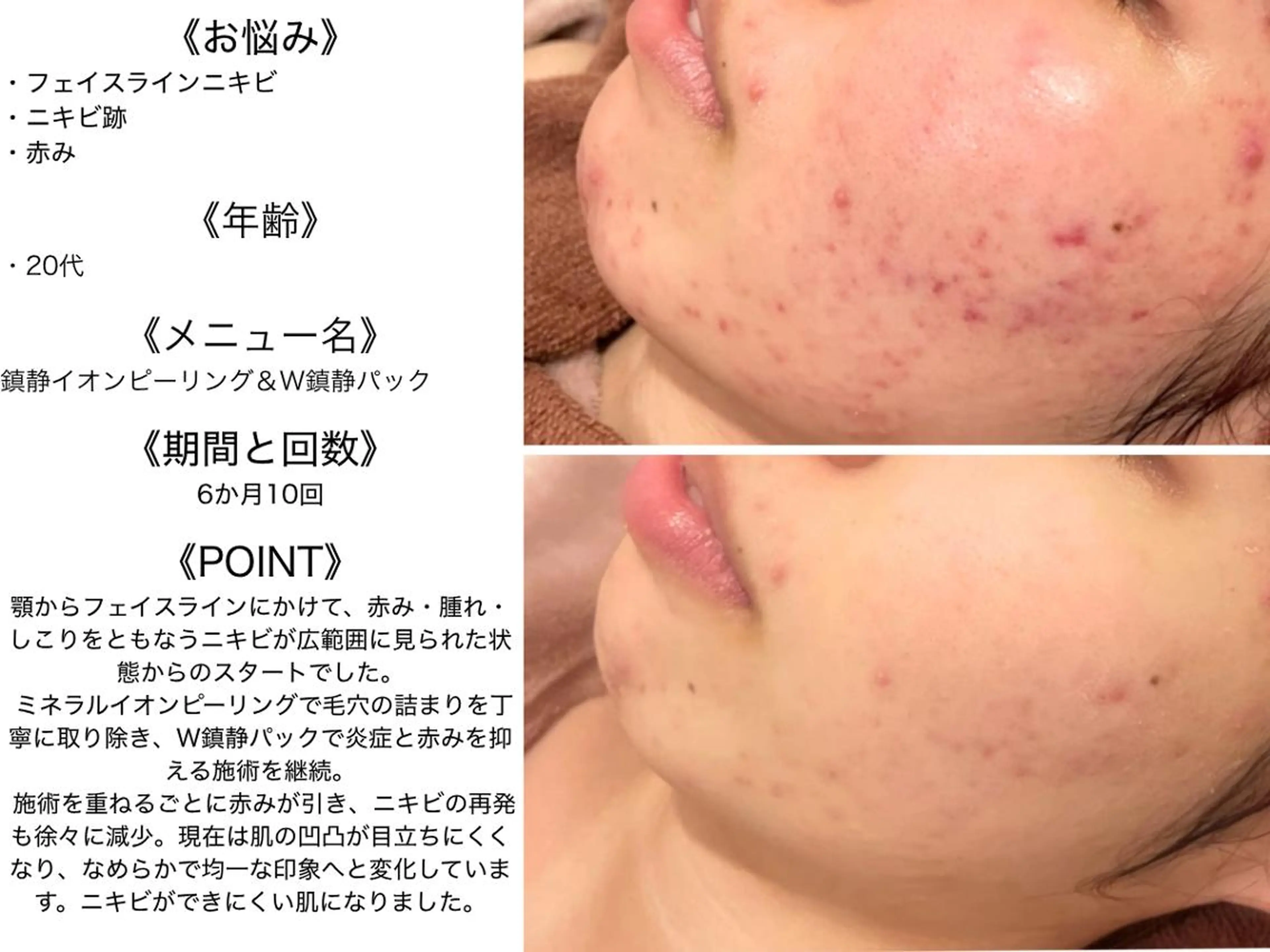 エステ リラク ニキビ特化型エステ 🍋最短で肌質改善のエステ・リラクイメージ