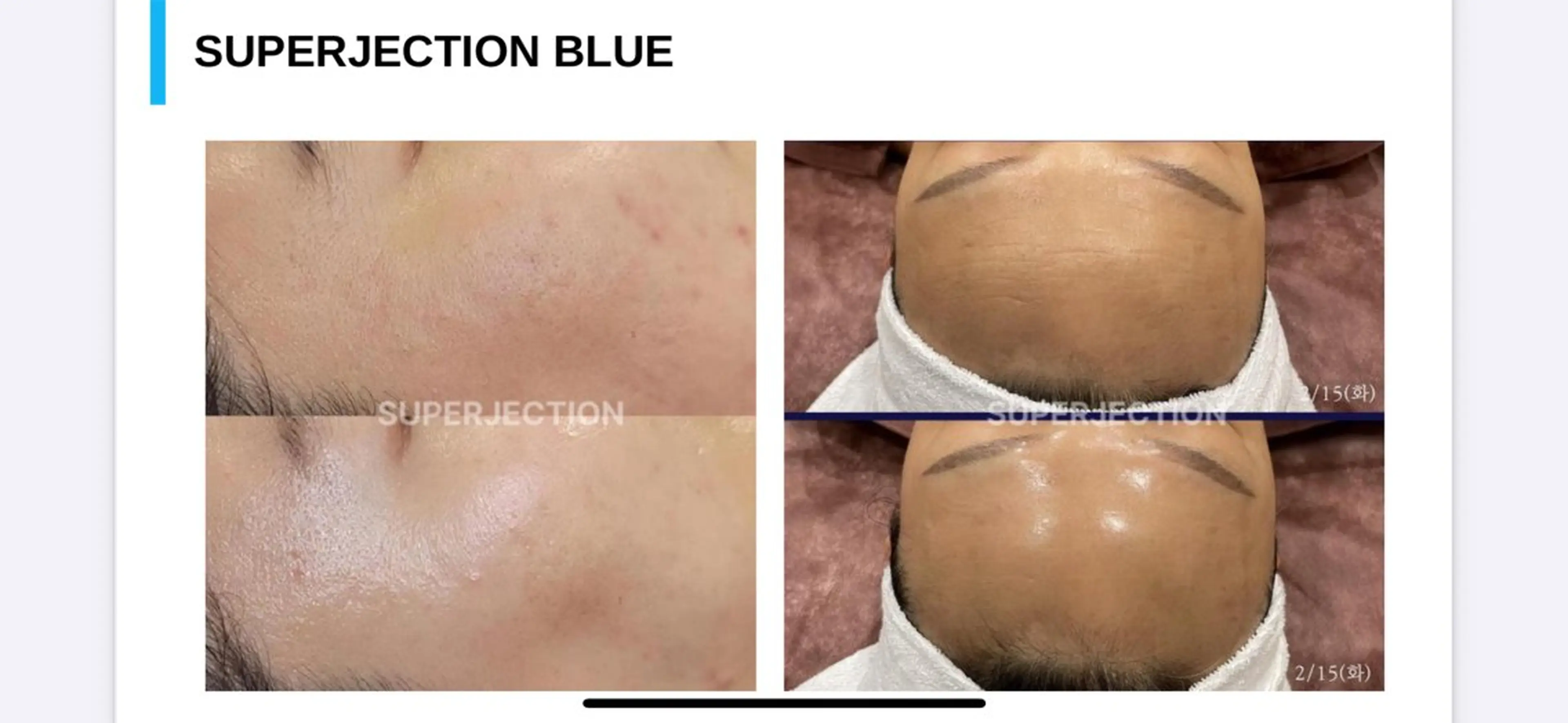 【SuperJection レチナロイド】ハリ×ツヤ×トーンupの肌質改善 30代からの肌を劇的に変える！の写真