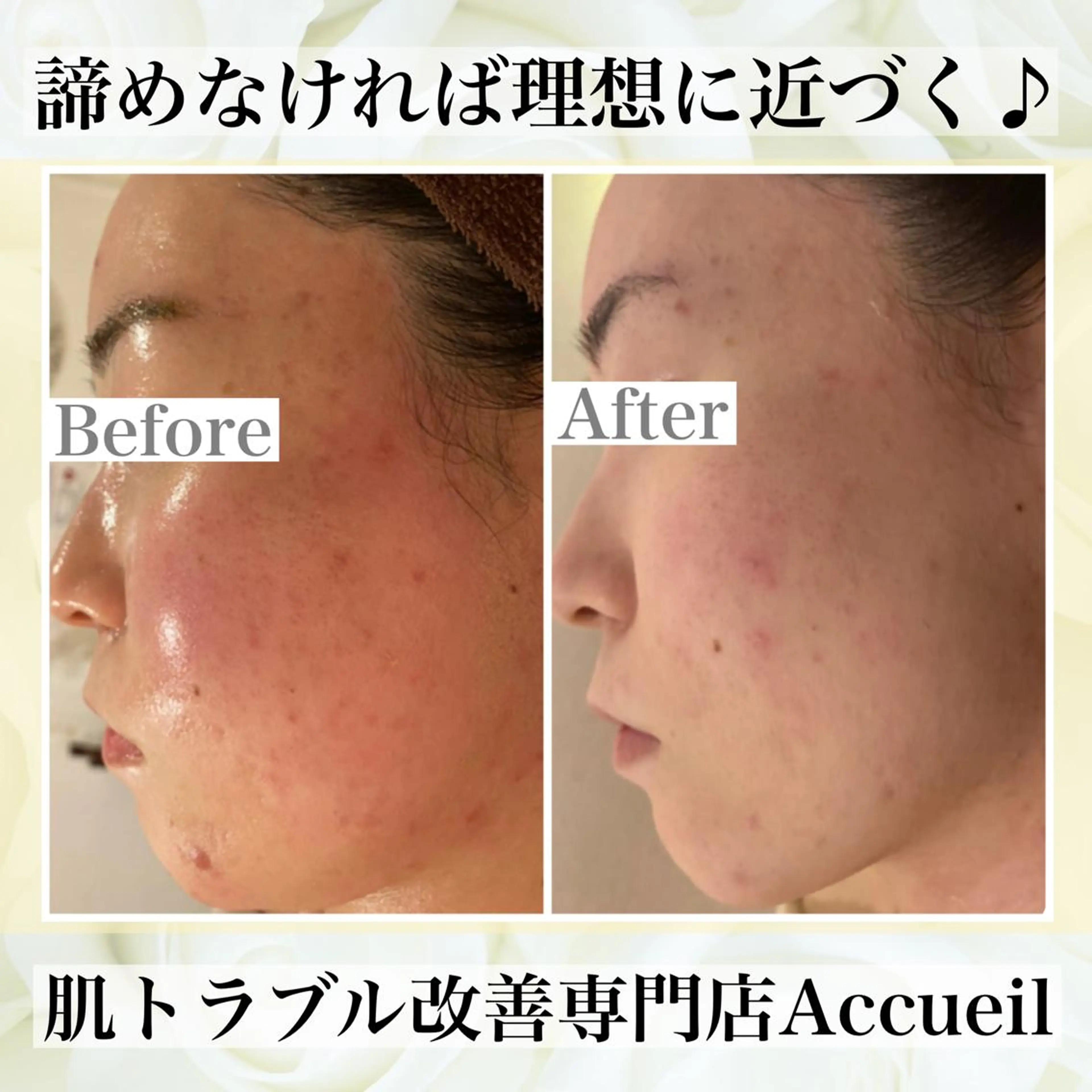 🔥3か月で肌革命 🔥ニキビ専門店のエステ・リラクイメージ