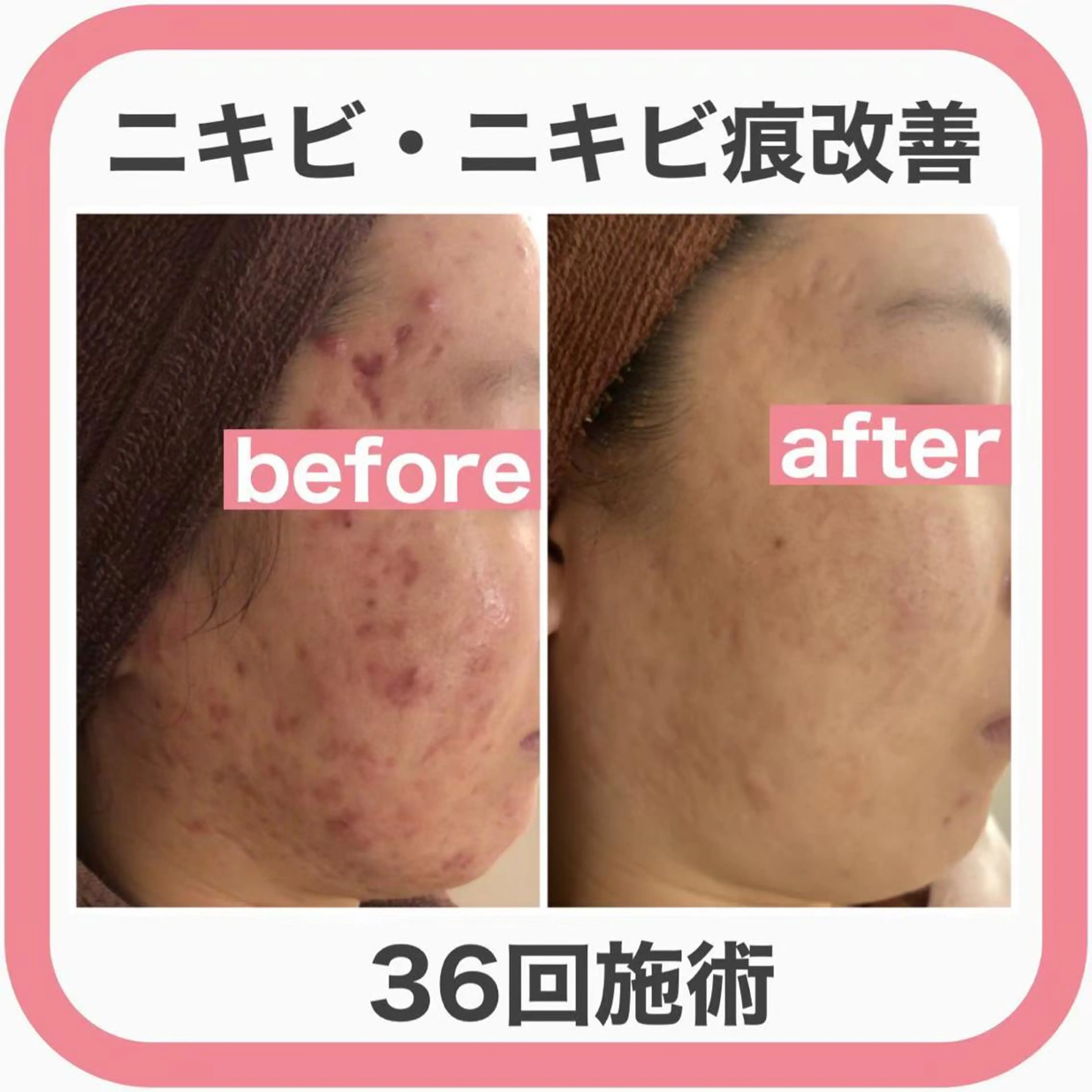 ニキビ跡改善専門🔥 医療にはできない改善のエステ・リラクイメージ
