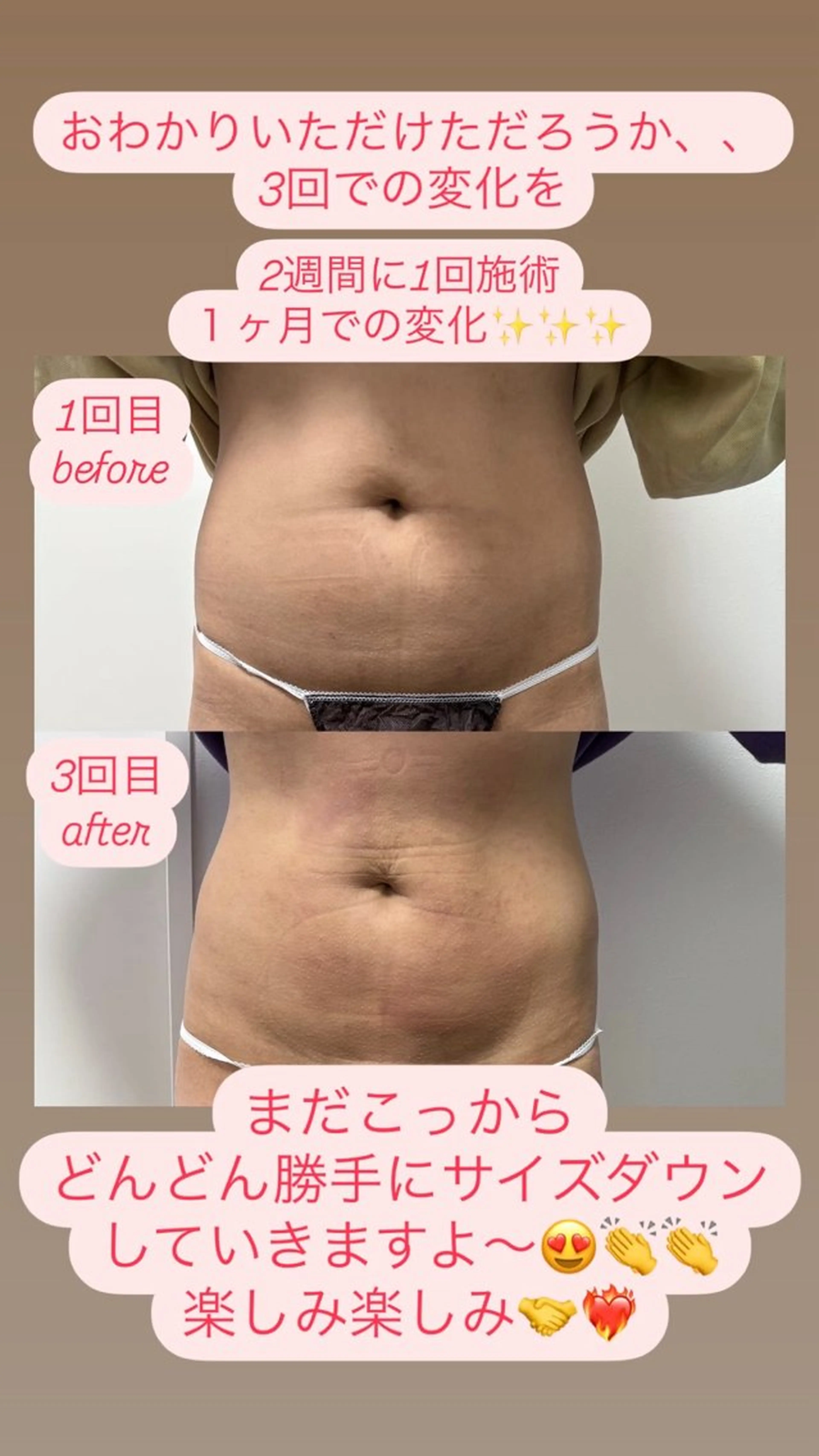 Miiju.所属・Miiju. 石巻市 脂肪冷却  鈴木のエステ・リラクイメージ