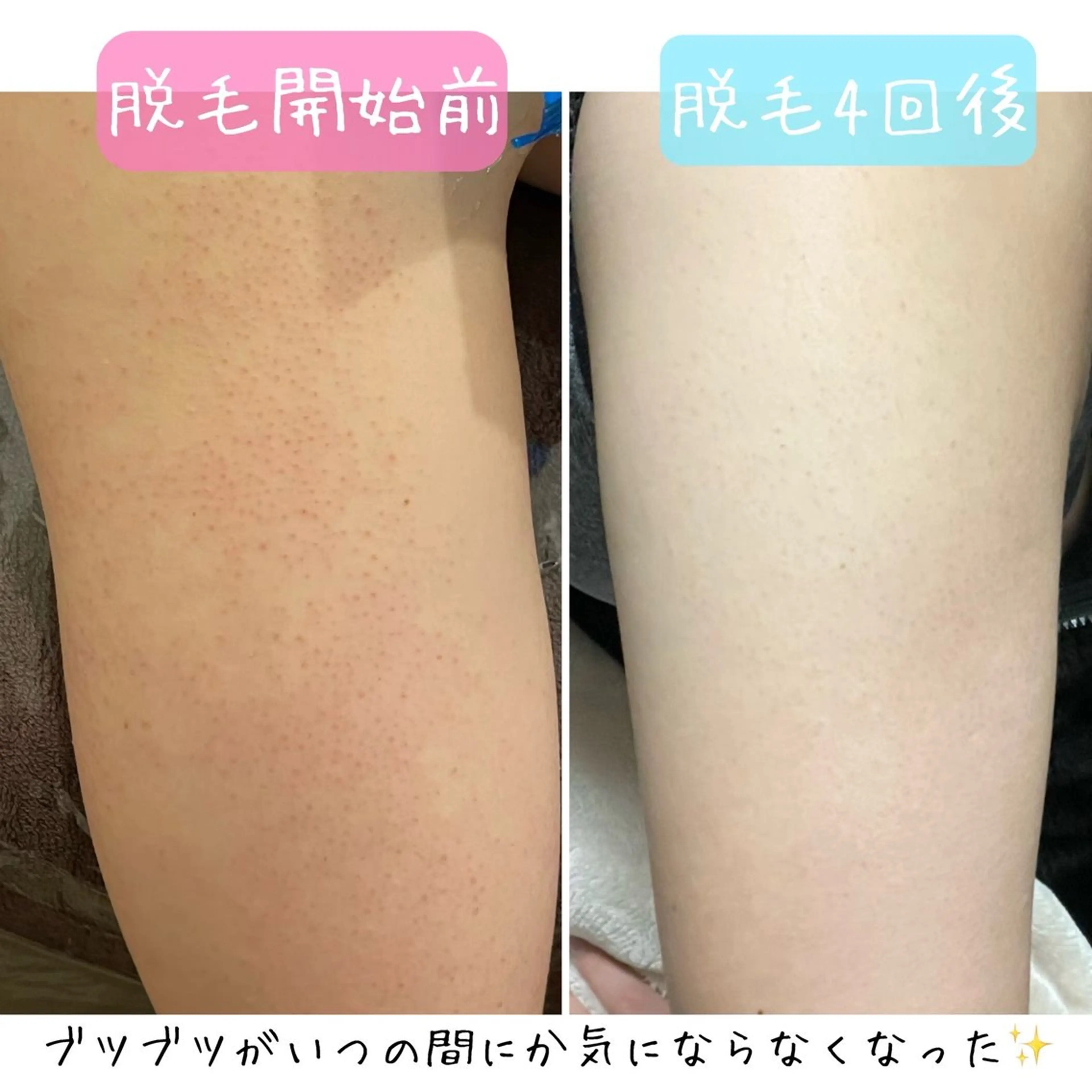 【18​〜​29歳女性限定】ワキ体験付き脱毛カウンセリングクーポンの写真