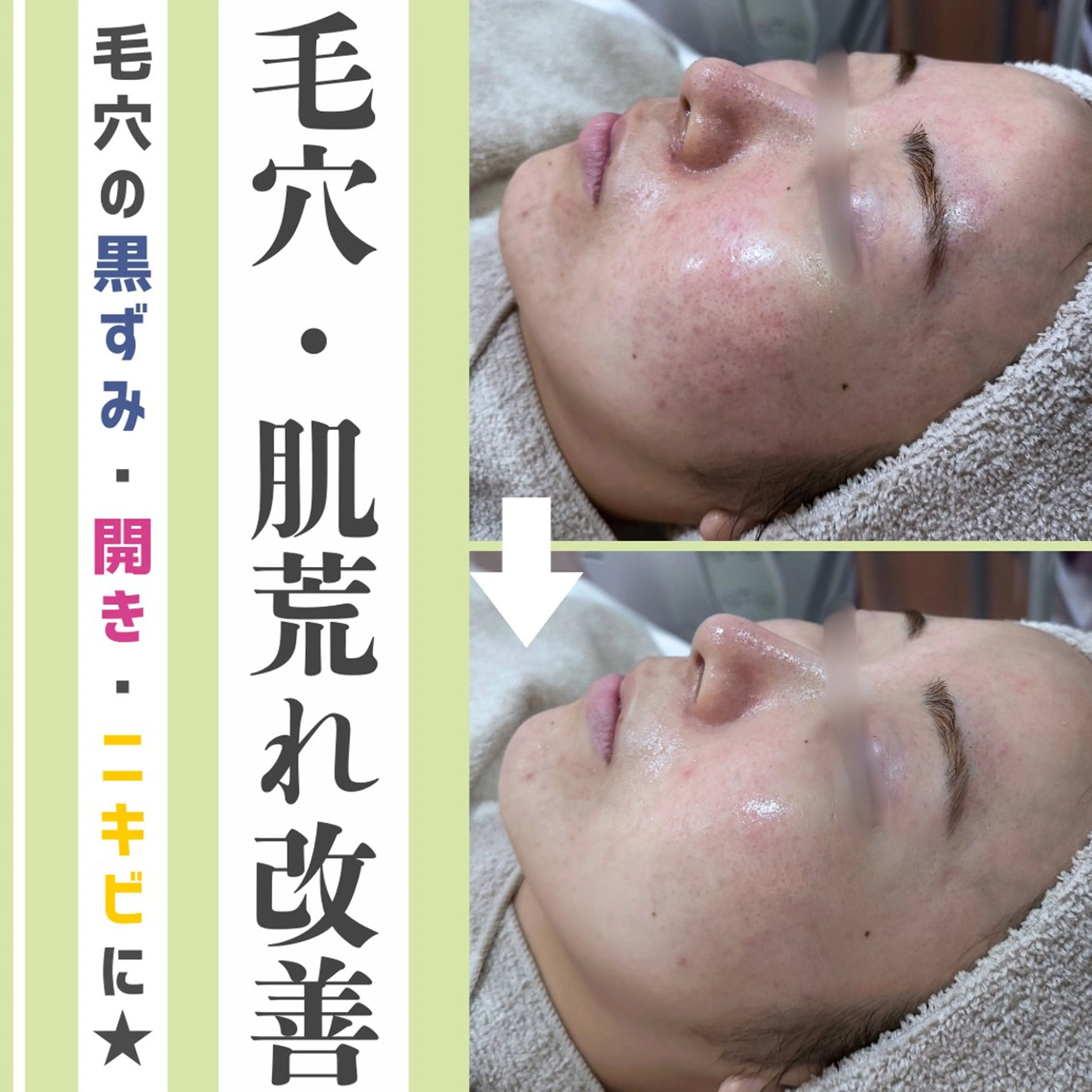 〈毛穴悩みに👃〉毛穴洗浄+ハーブピーリング(ダウンタイム&剥離なし)　70分6,000円の写真