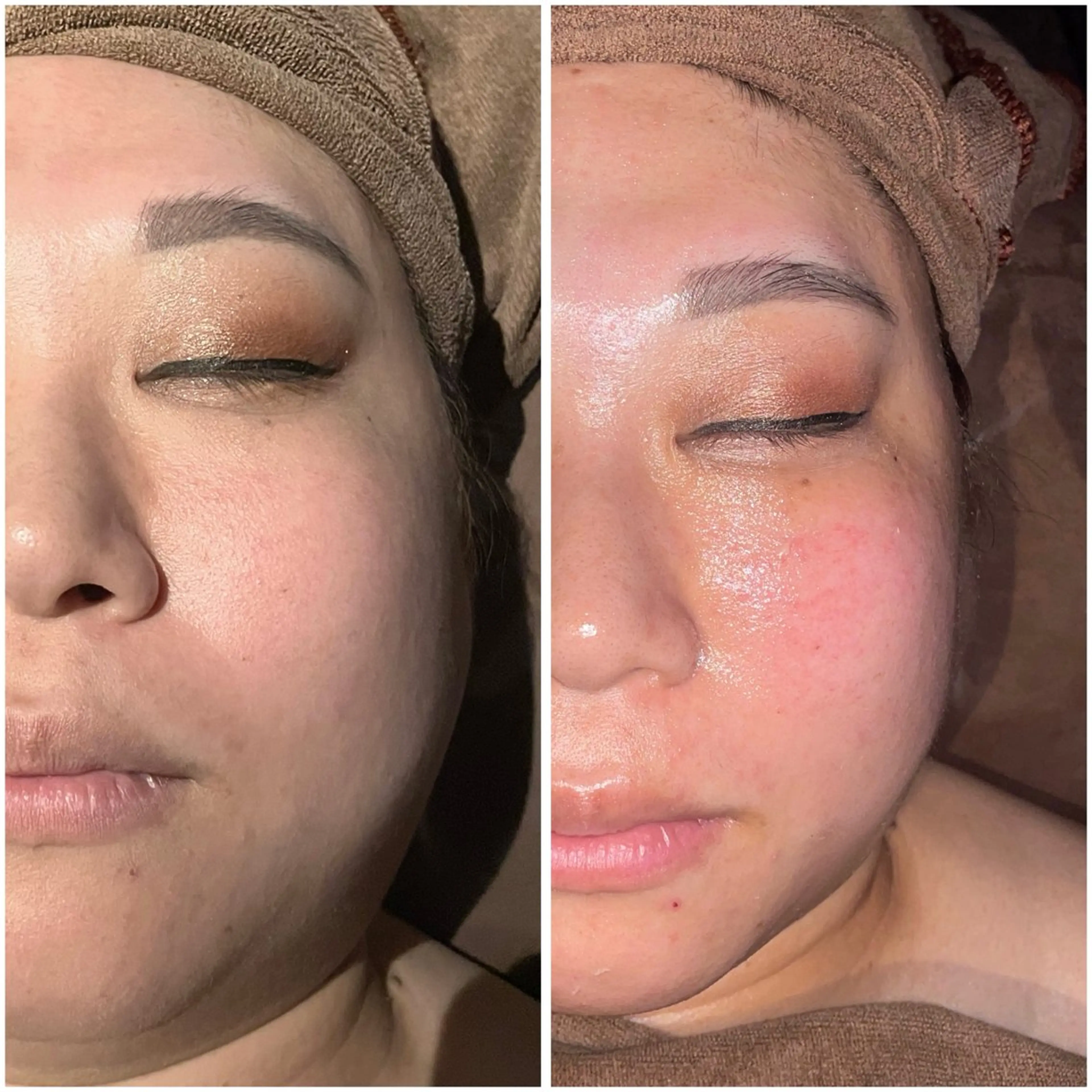 🌟【練習モデル募集】ぽにょ取り💆‍♀️ ラジオ波でスッキリ小顔✨《痛みなし・ダウンタイムなし・エイジングケア》の写真