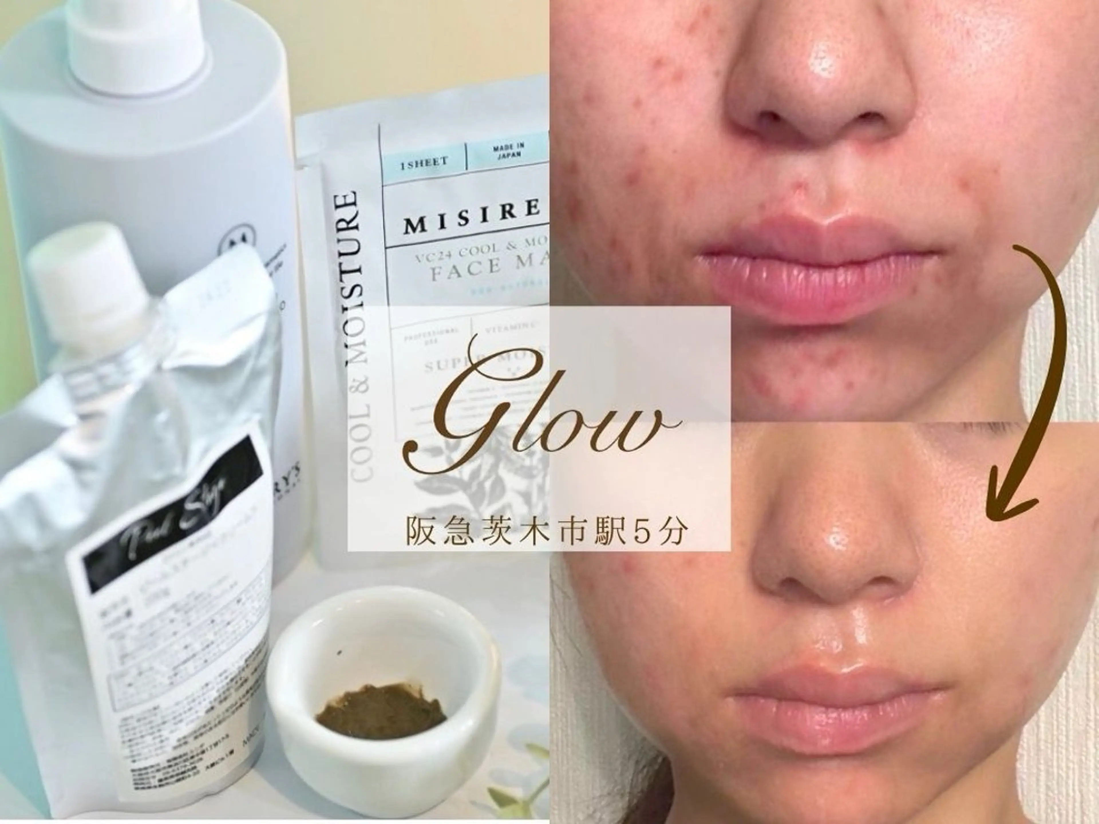 エステ リラク 【医療提携】幹細胞艶玉ハーブピーリング　glow所属・肌質改善専門 【医療提携】glowのエステ・リラクイメージ