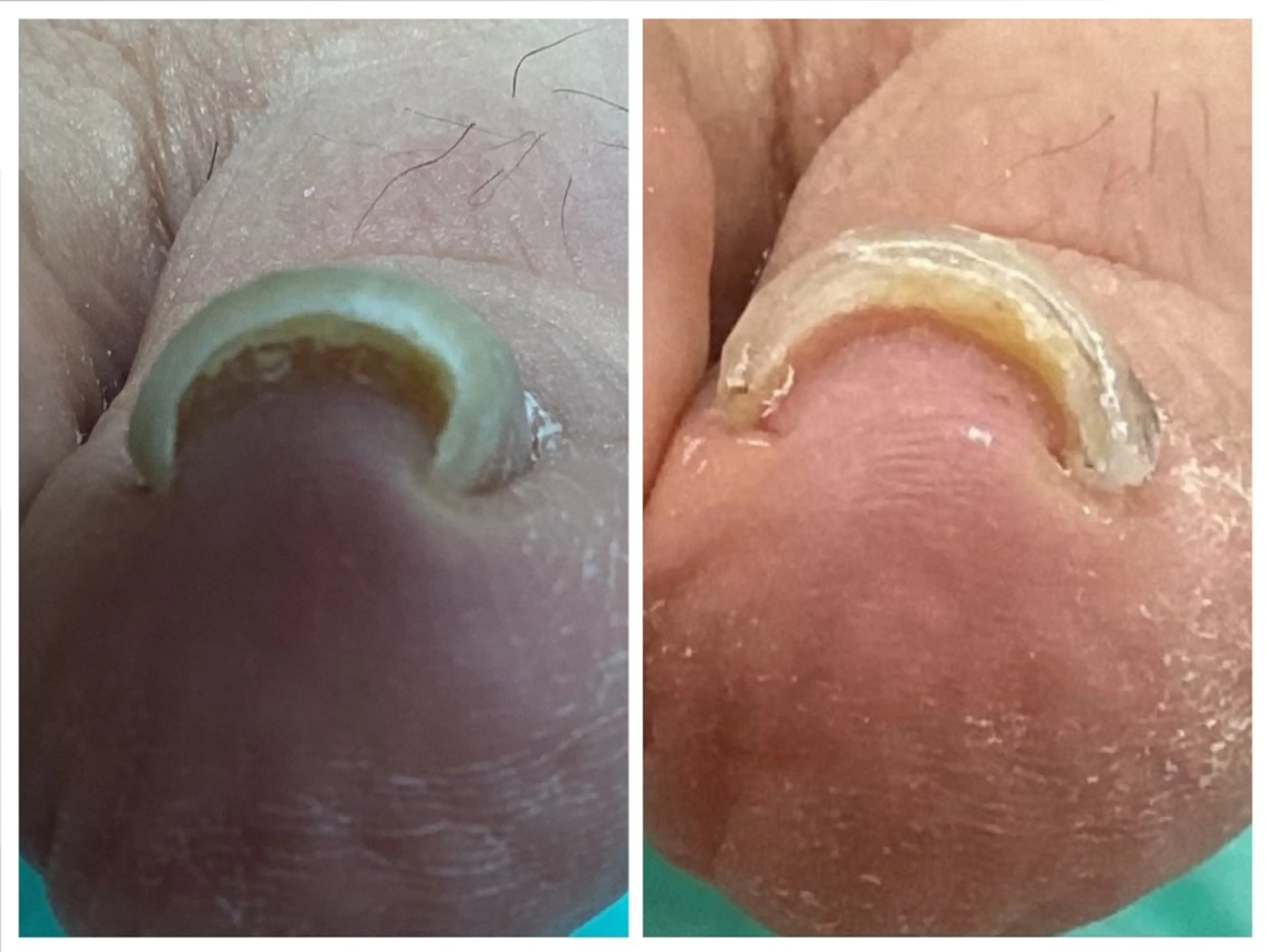 巻き爪補正店 大阪なんば店のネイルデザイン