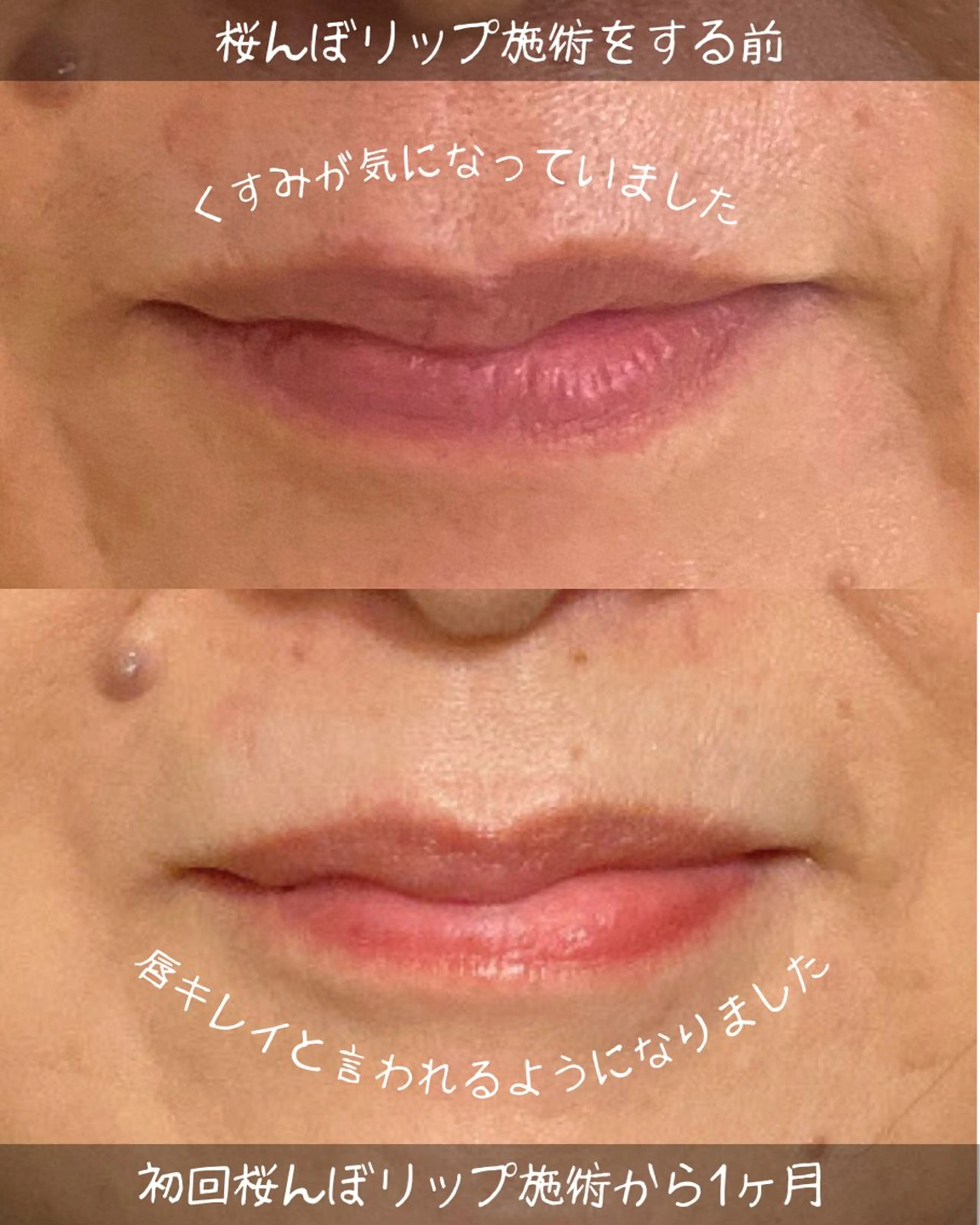 【唇のくすみが気になる方】🌸桜んぼリップカウンセリング＋ドライヘッドマッサージ30分／2,000円🌸の写真
