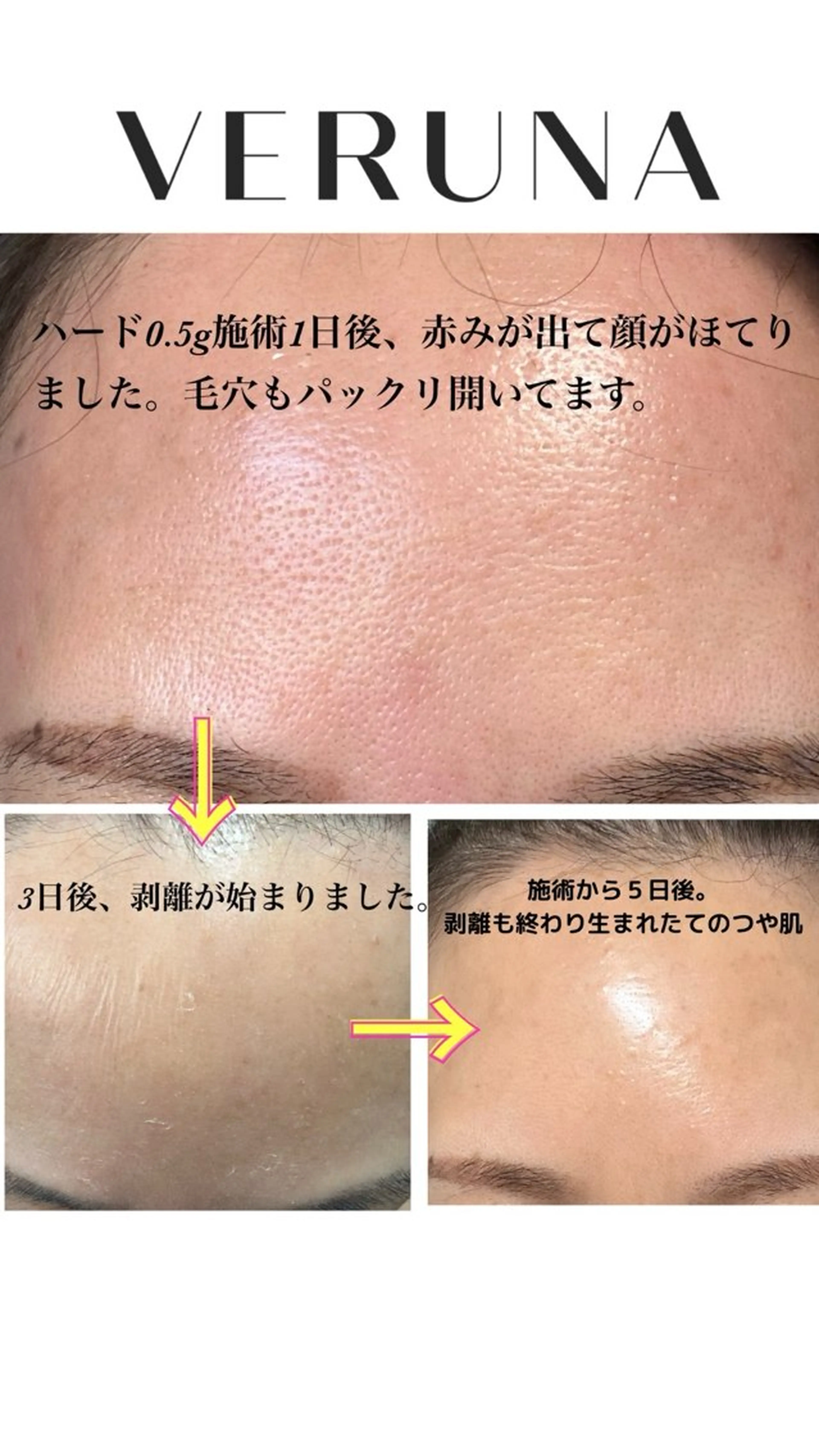 剥離有りハーブピーリングのダウンタイムの様子です。 当日は