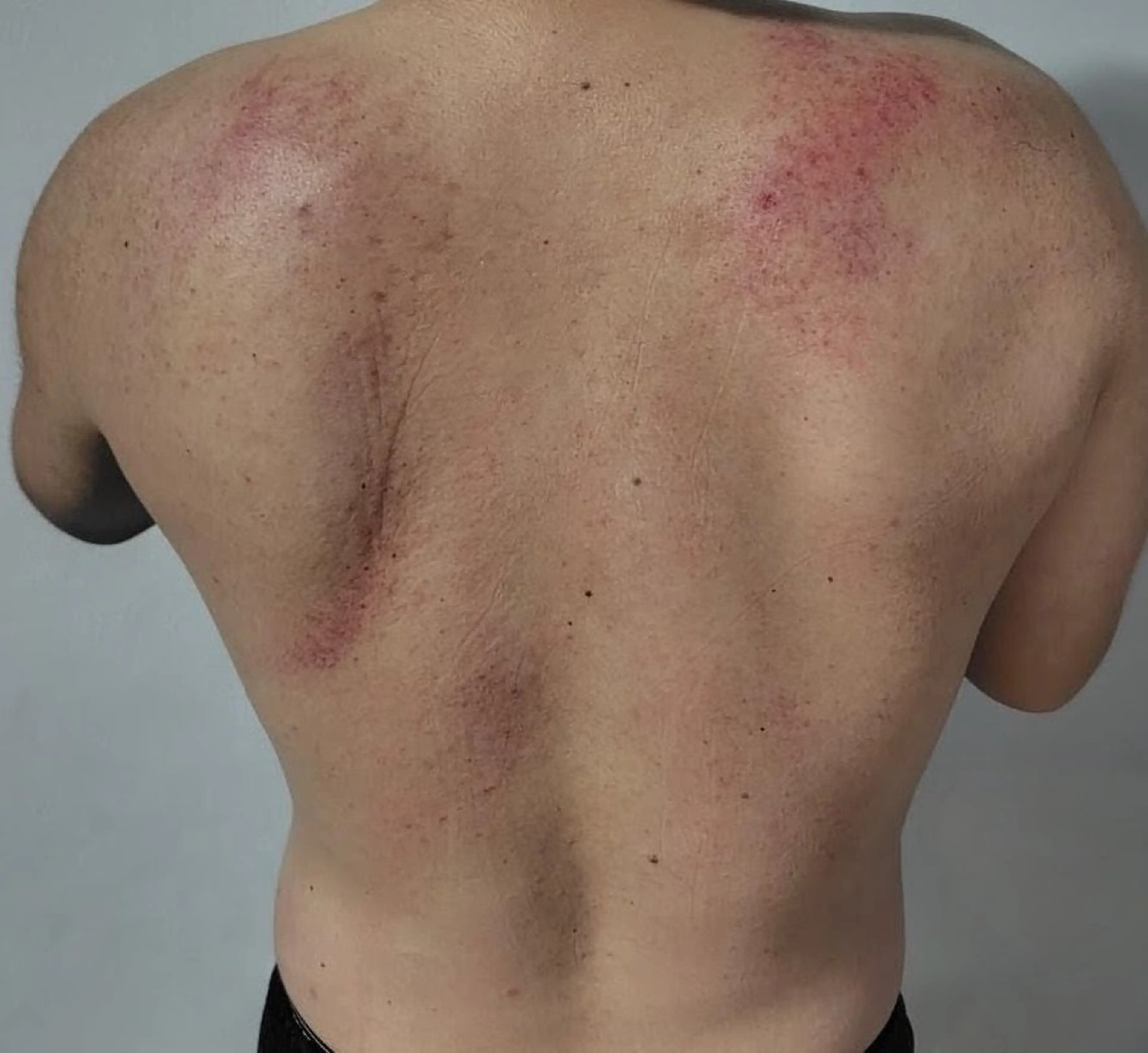 男性　スライドカッピングの写真