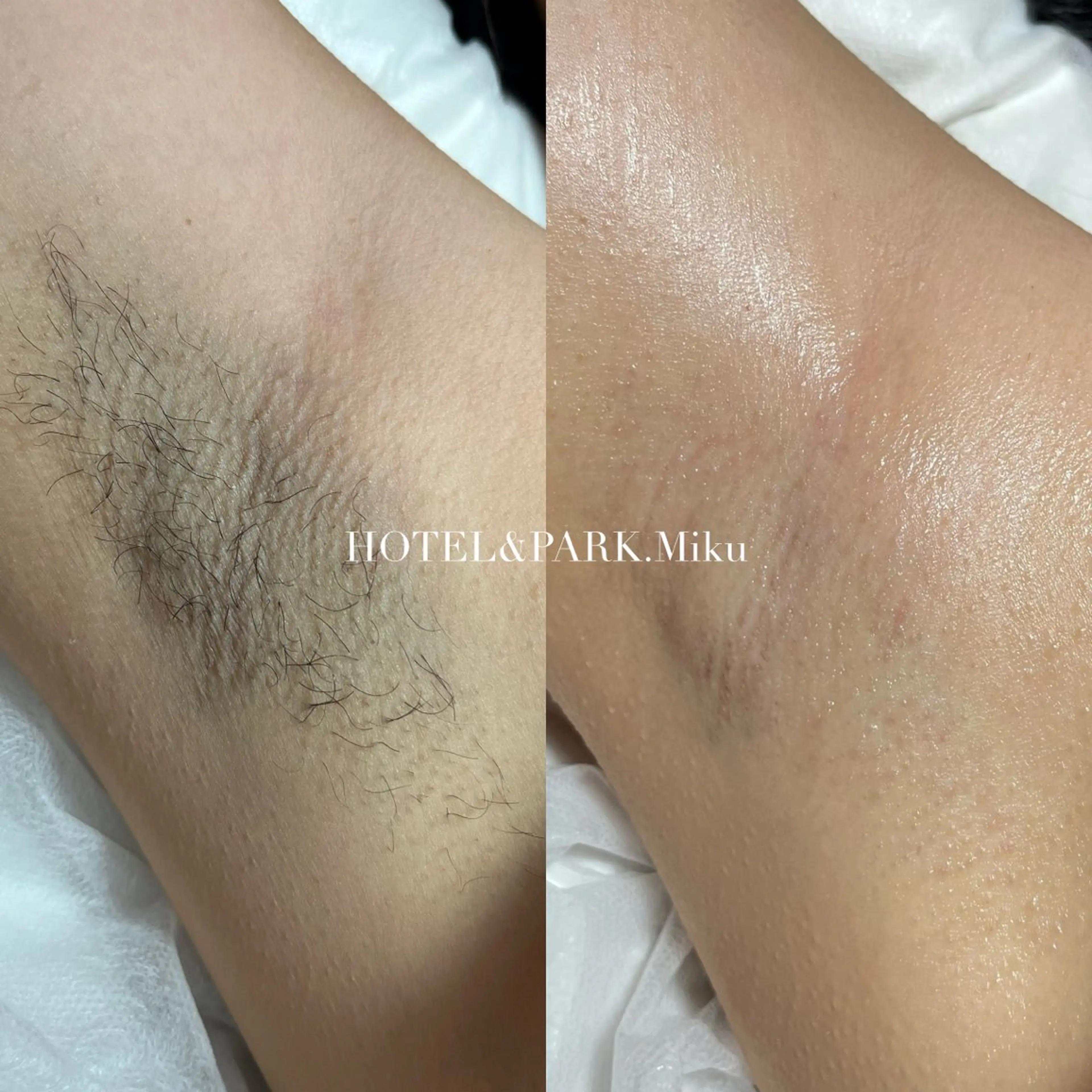 7/31~8/7限定⛱️【VIO+両脇ワックス脱毛】の写真