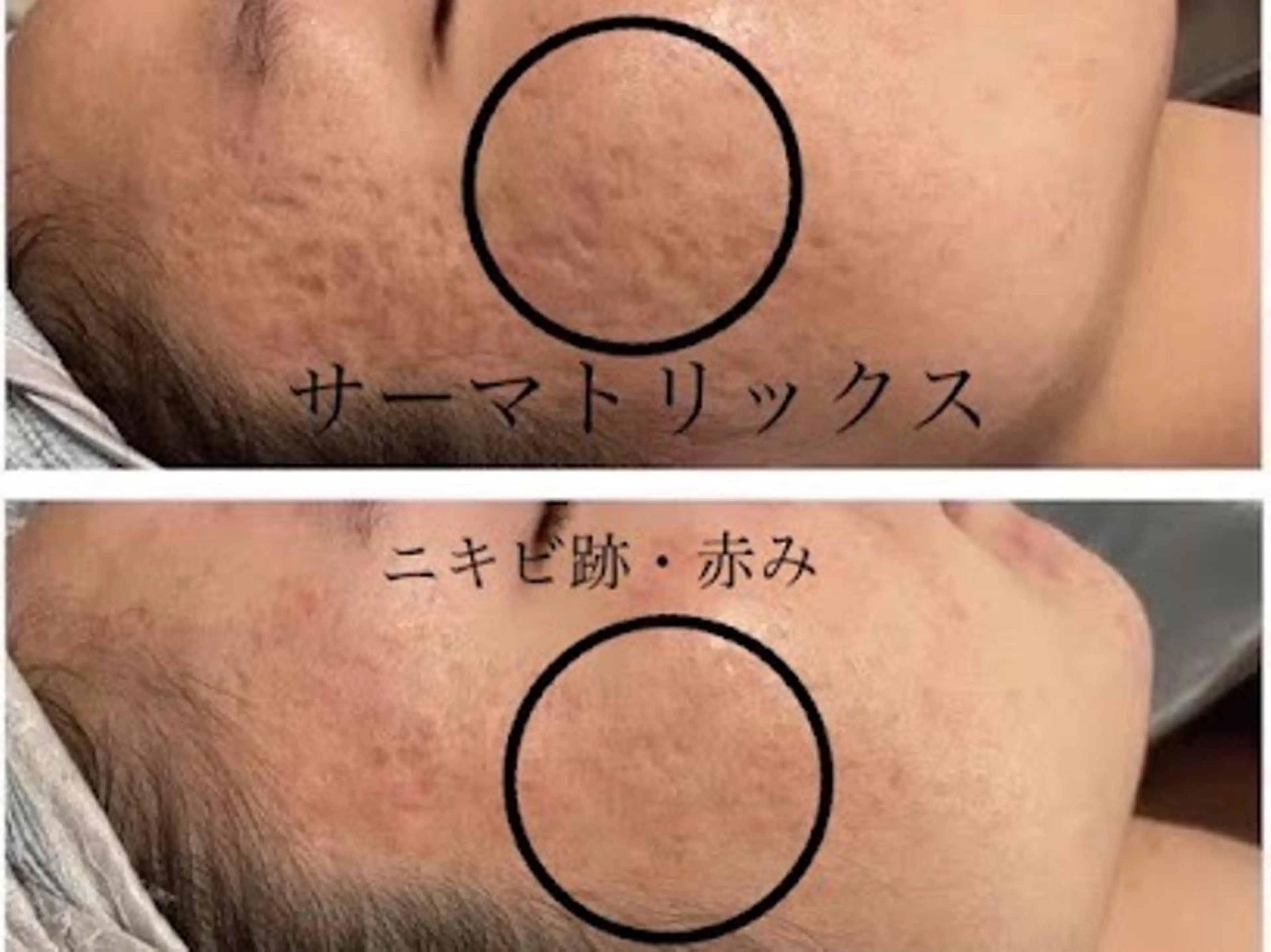 凸凹頬徹底ケアコース【頬のニキビ凸凹クレーター跡をしっかりケア】　5500円の写真