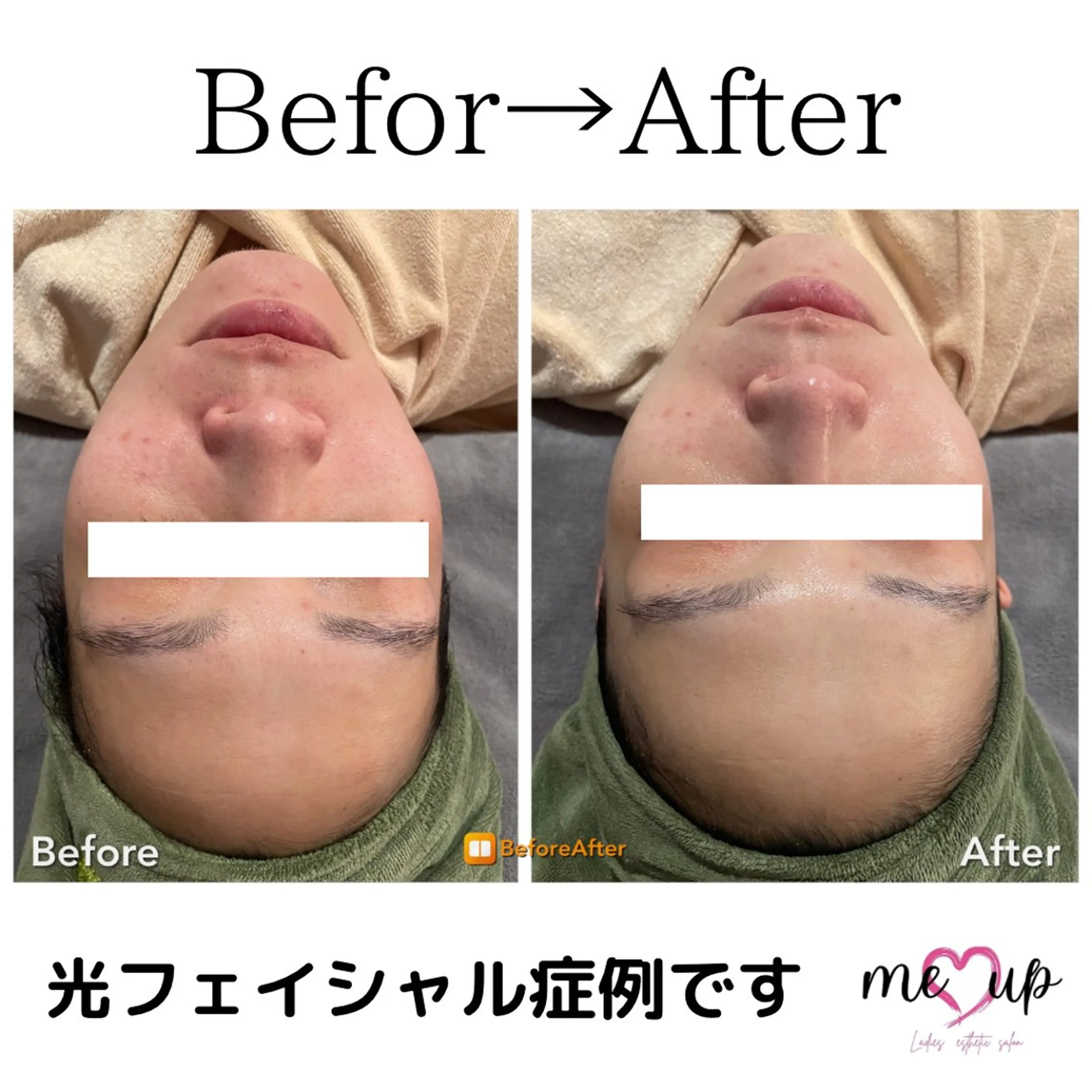 エステ Meupニキビ専門店 背中/ハーブ/ララのその他イメージ