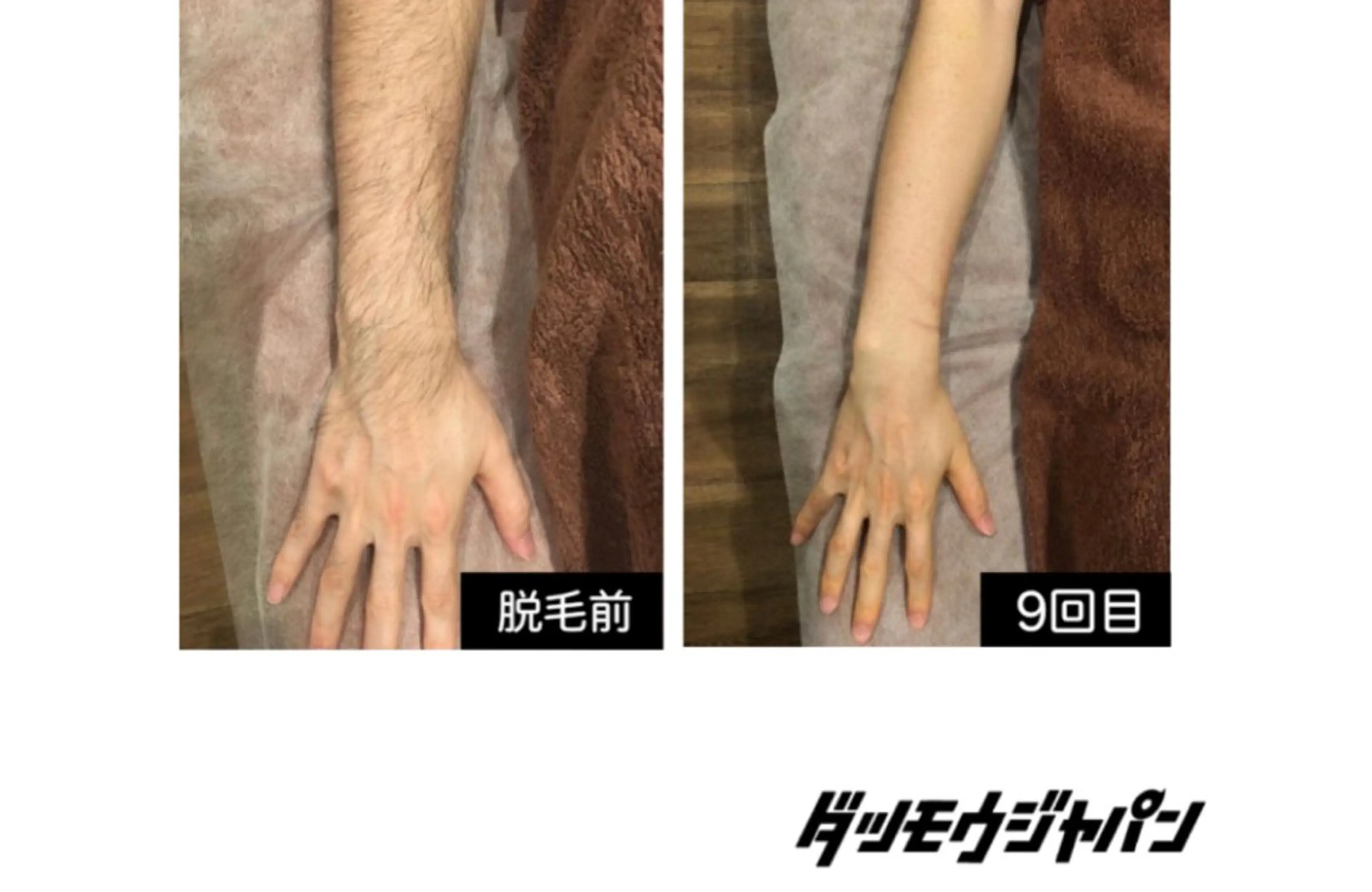 手･腕脱毛(手の甲･指,両ヒジ上･下)の写真