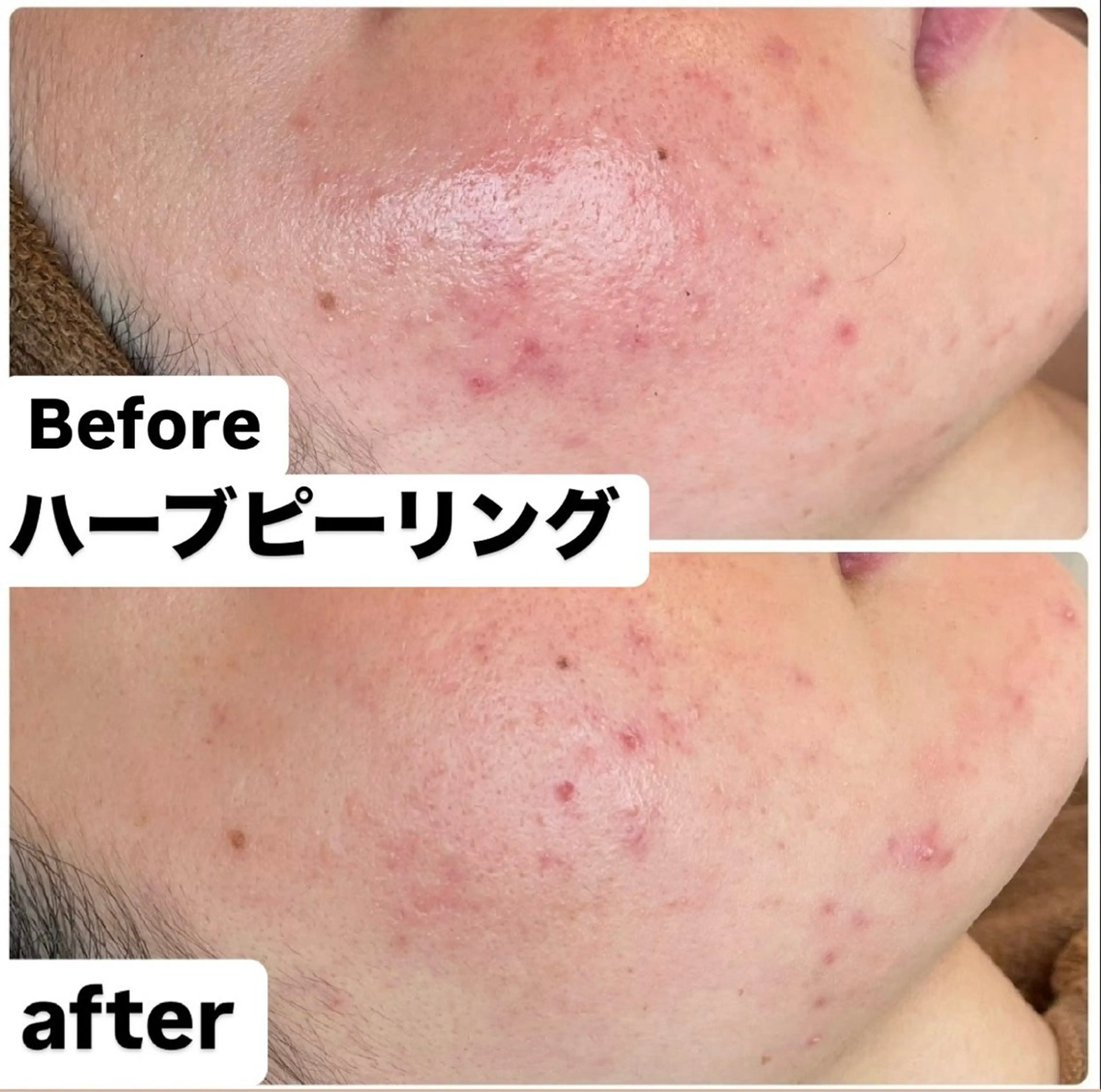 ハーブピーリング1g＋デコルテリンパ＋プレミアムゲルLDM +ヒト幹細胞パックの写真