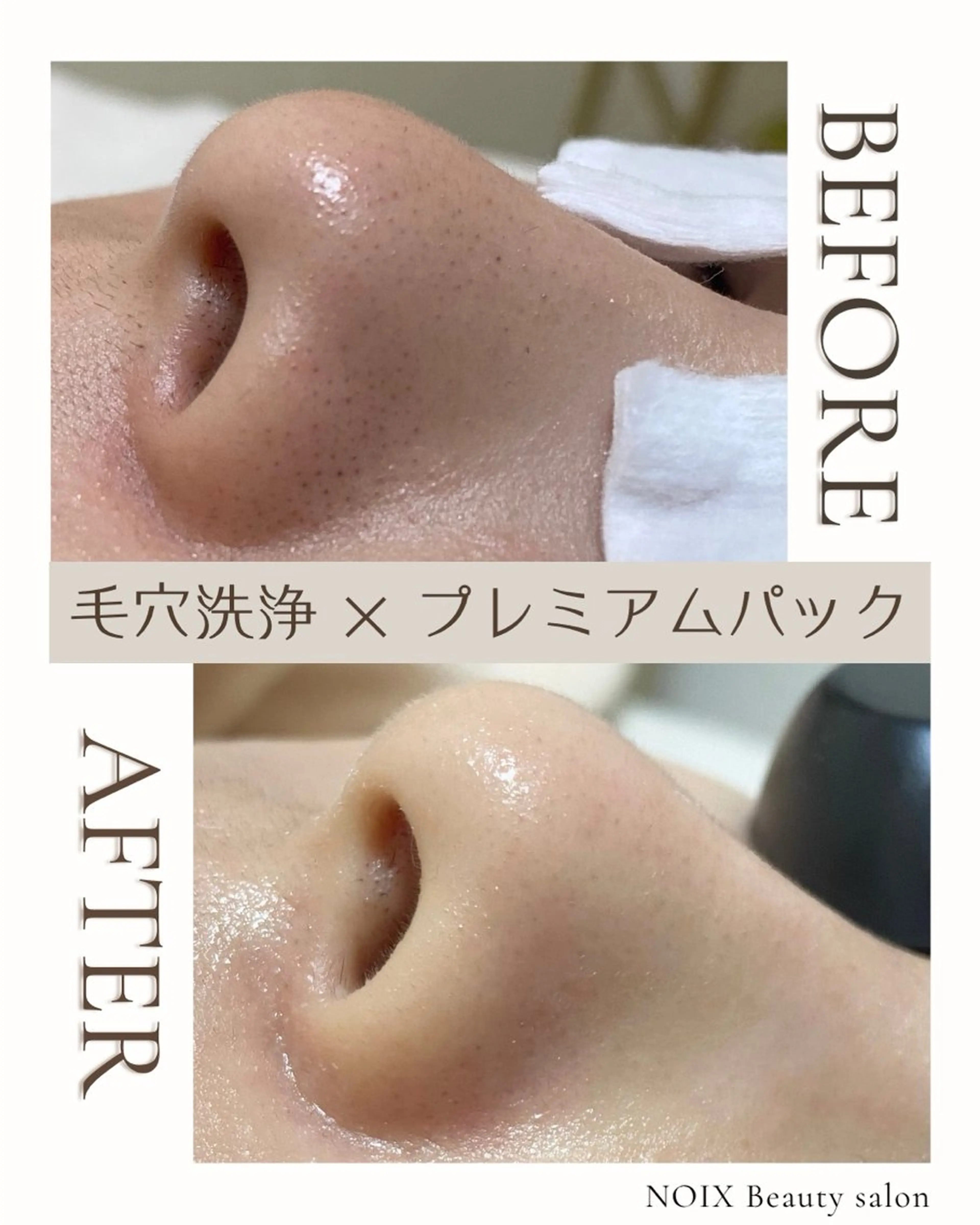 鼻スッキリ美肌コース🫧毛穴洗浄（鼻のみ）＋美容液導入＋引き締めパック✨の写真