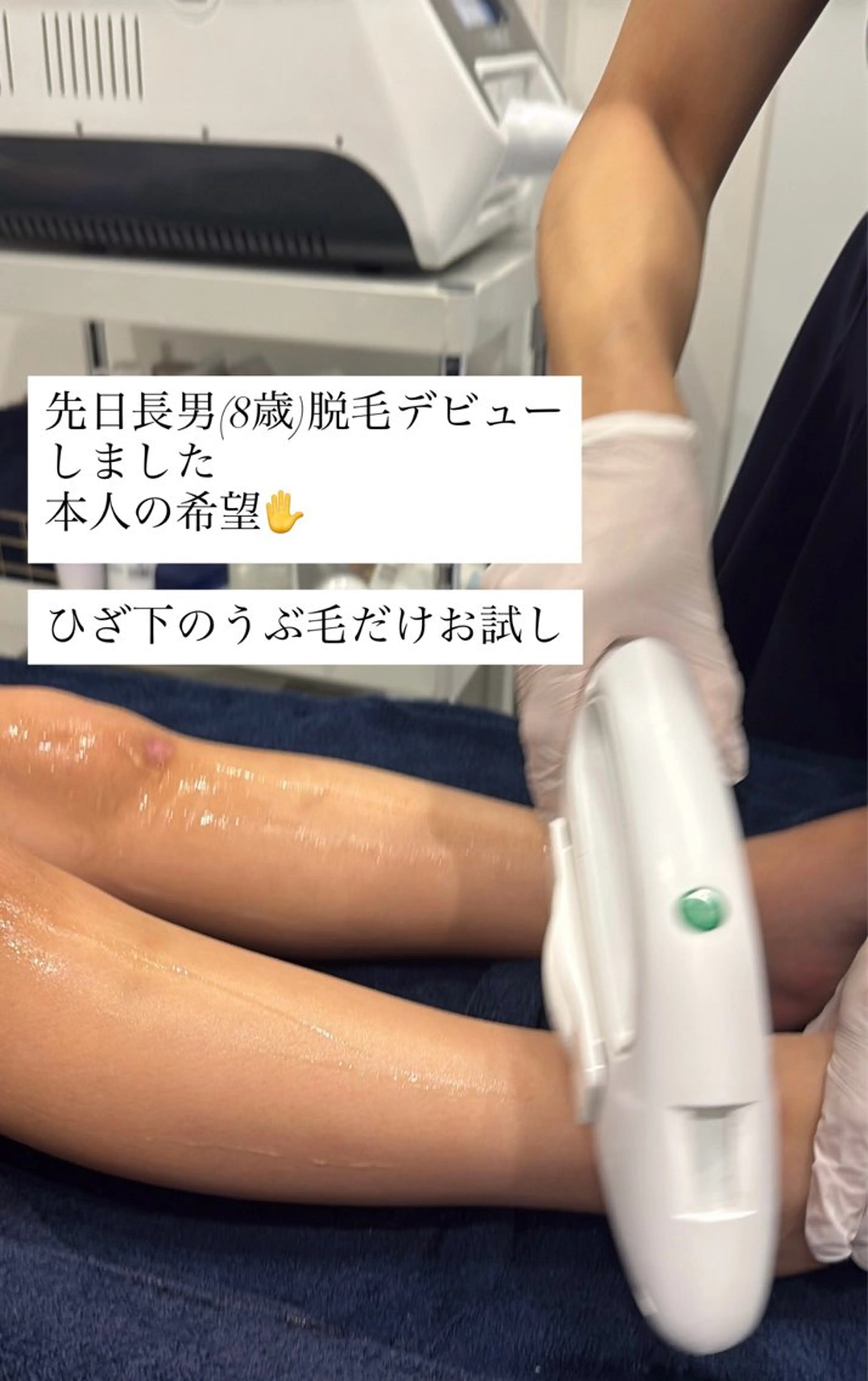 ☆キッズ脱毛☆無料カウンセリング＋１箇所お試し脱毛体験の写真