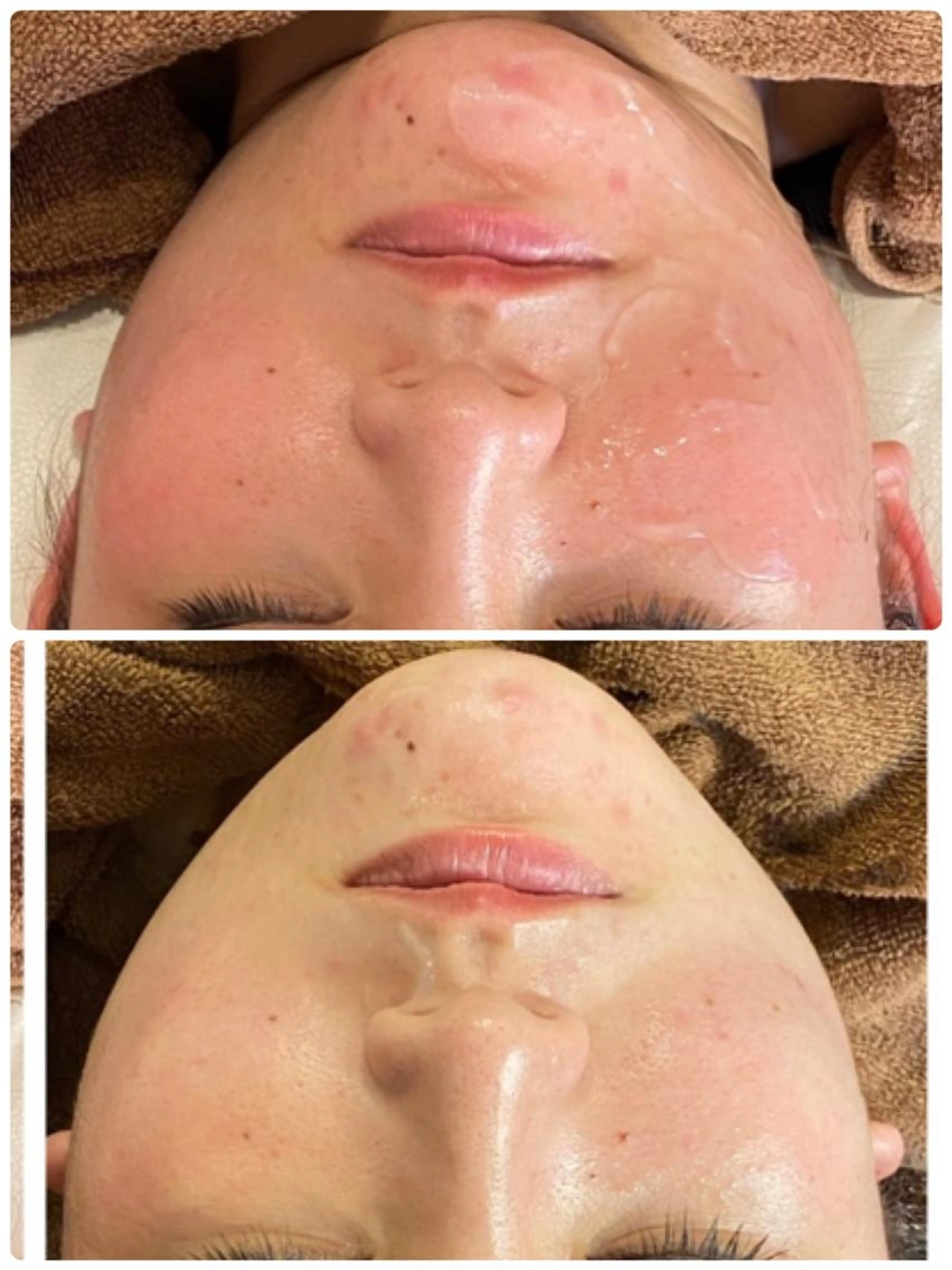 5名限定‼️小顔リフトアップ💎4000ショット💆‍♀️究極の小顔ケア✨の写真