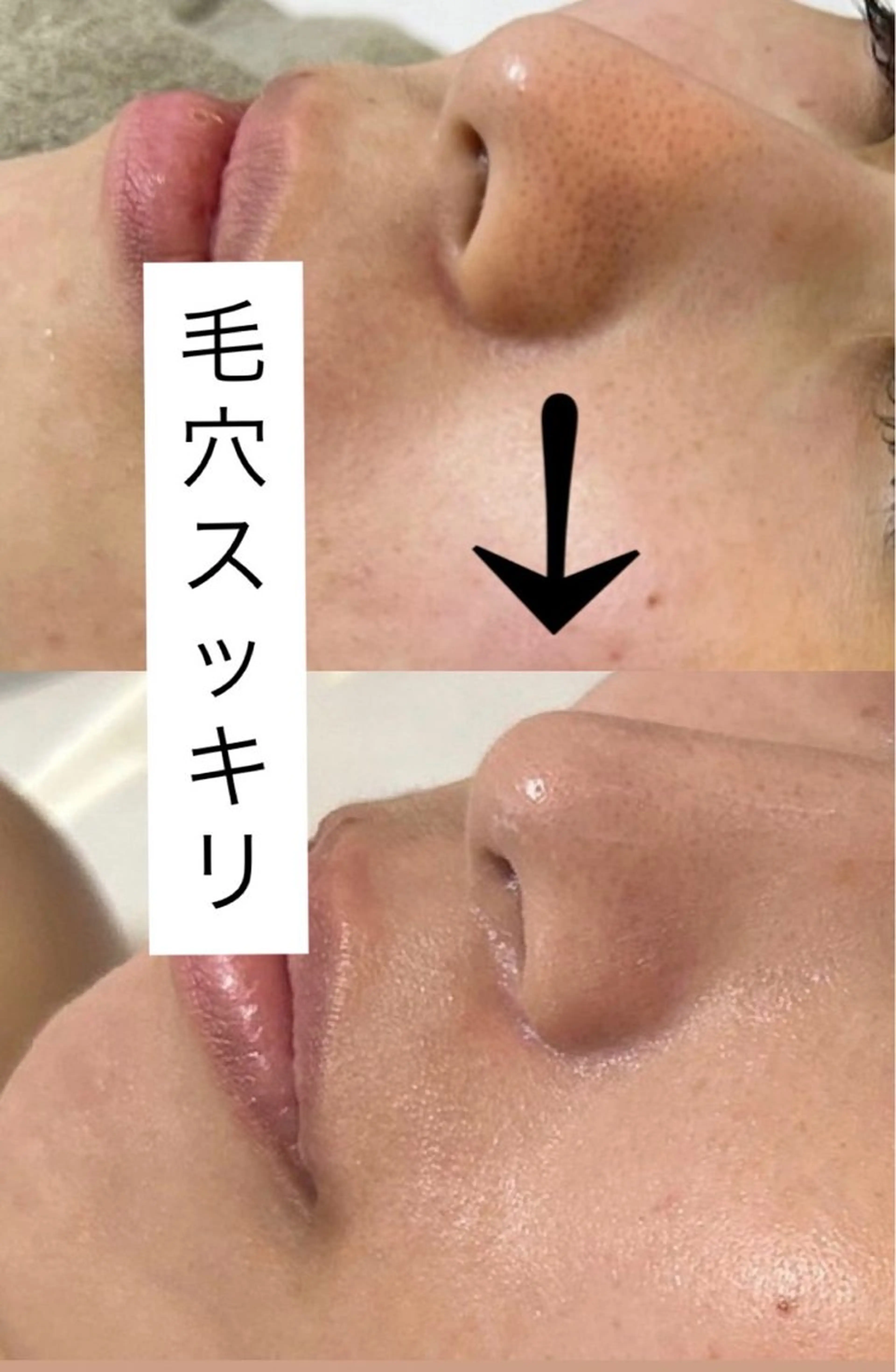 毛穴洗浄🧹✨️皮脂詰まり毛穴の黒ずみへアプローチ♪【 練習モデル】の写真
