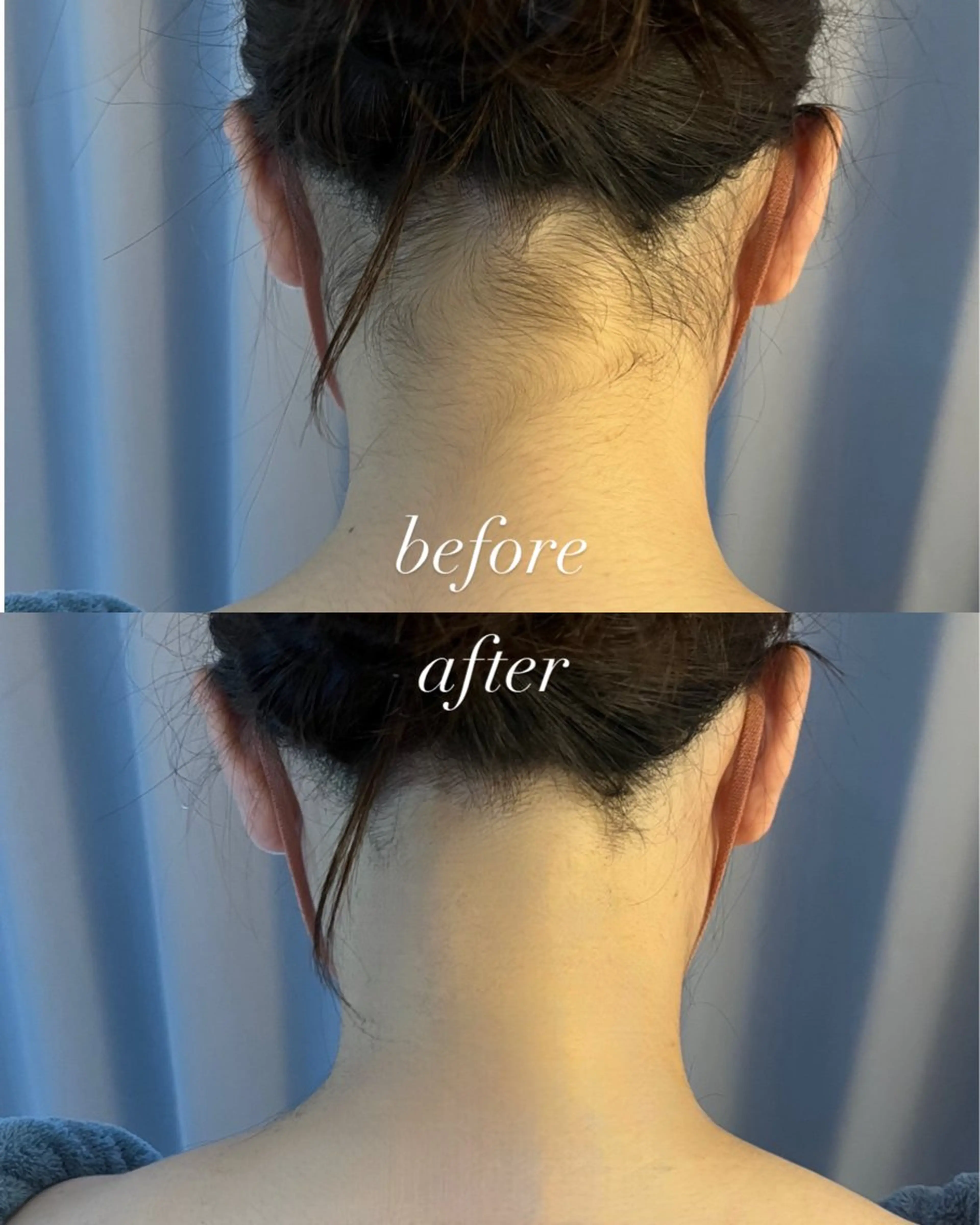 脱毛 うなじ脱毛/美肌脱毛 LABELのエステ・リラクイメージ