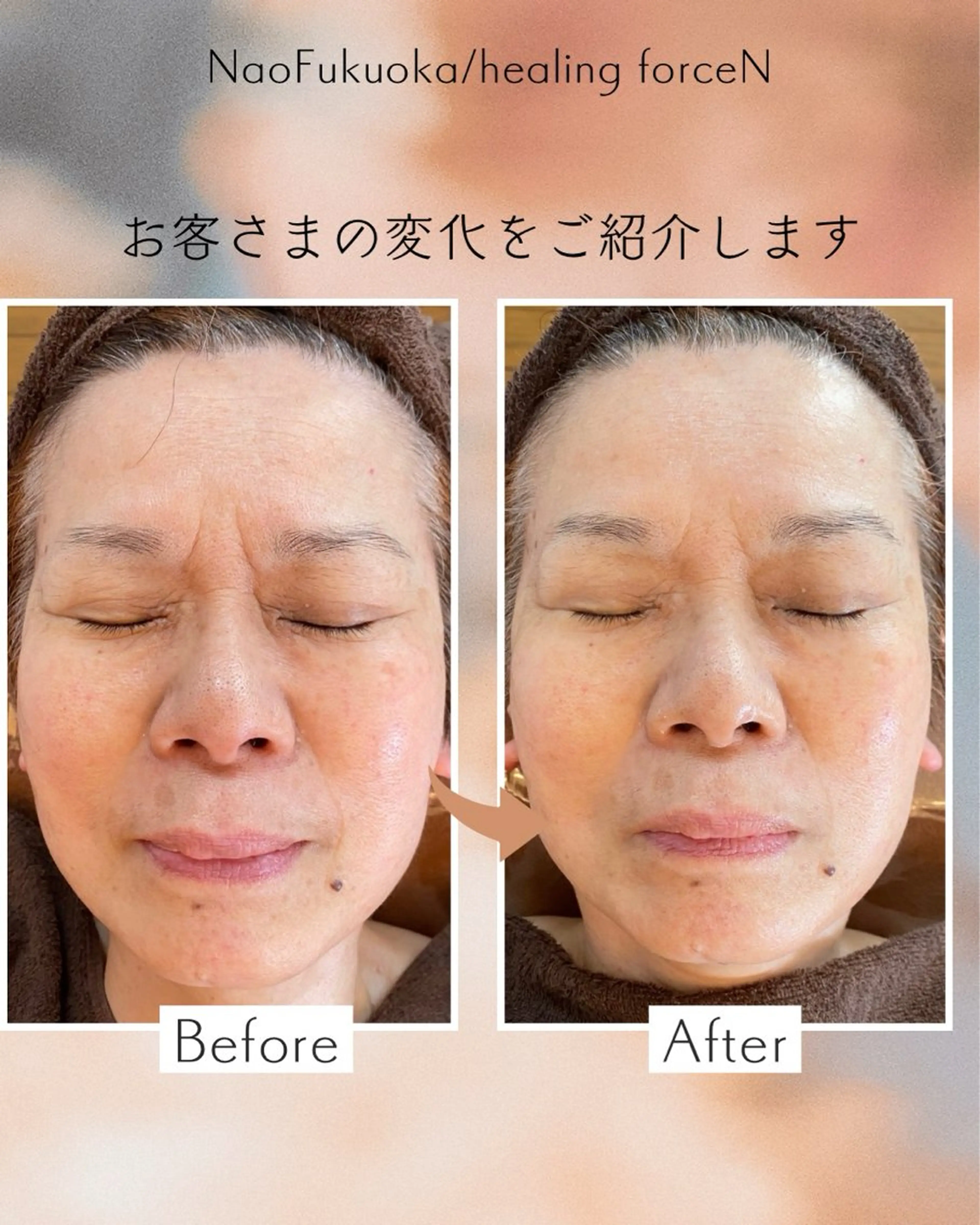 舟津式💆♀️美zen筋骨小顔トリートメント 🩷オールハンド&機器での引き上げ幹細胞導入🩷の写真