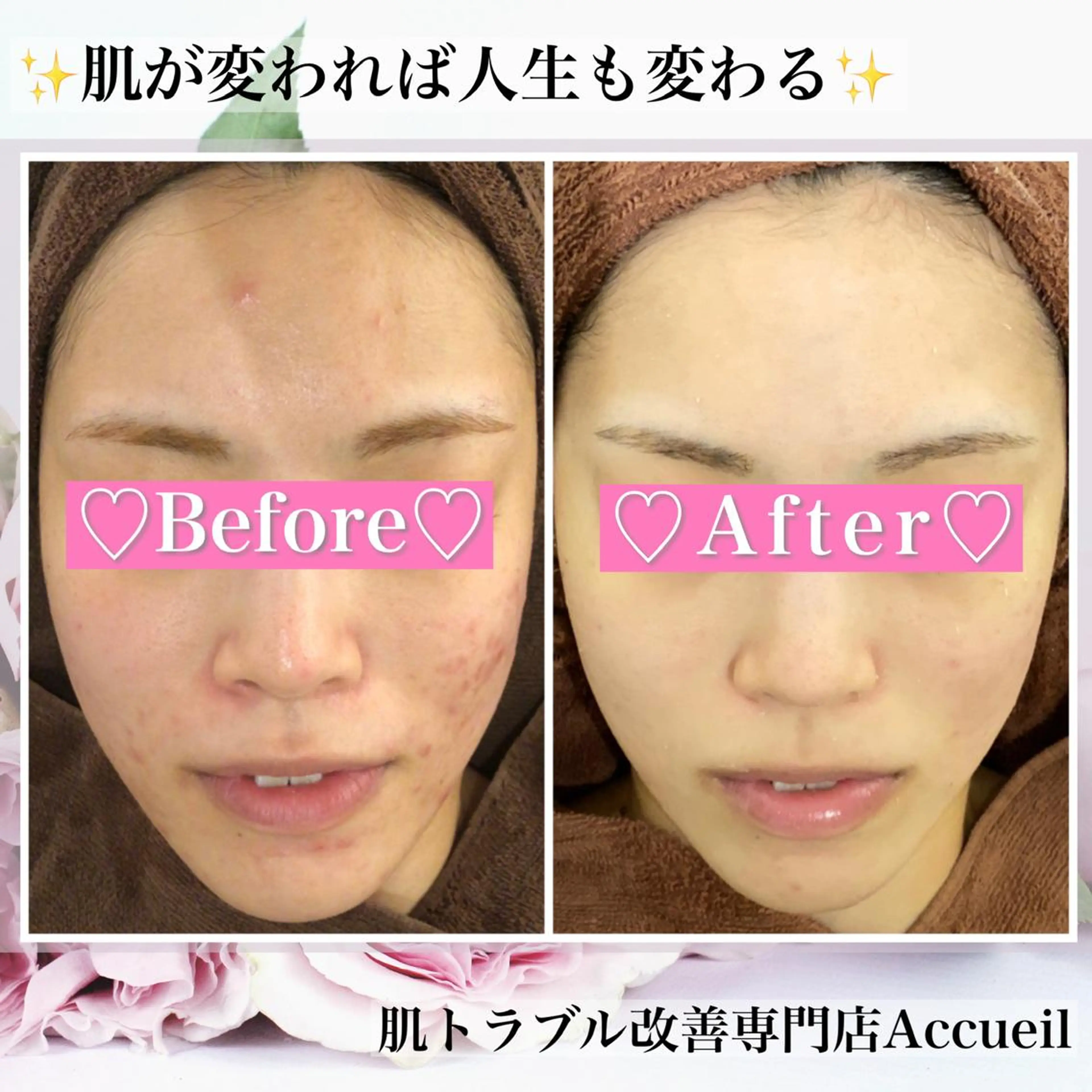 ミディアム カラー パーマ ヘアアレンジ メンズ キッズ ネイル マツエク・マツパ アイブロウ エステ リラク アクール　齋藤 ♡肌トラブル卒業のエステ・リラクイメージ