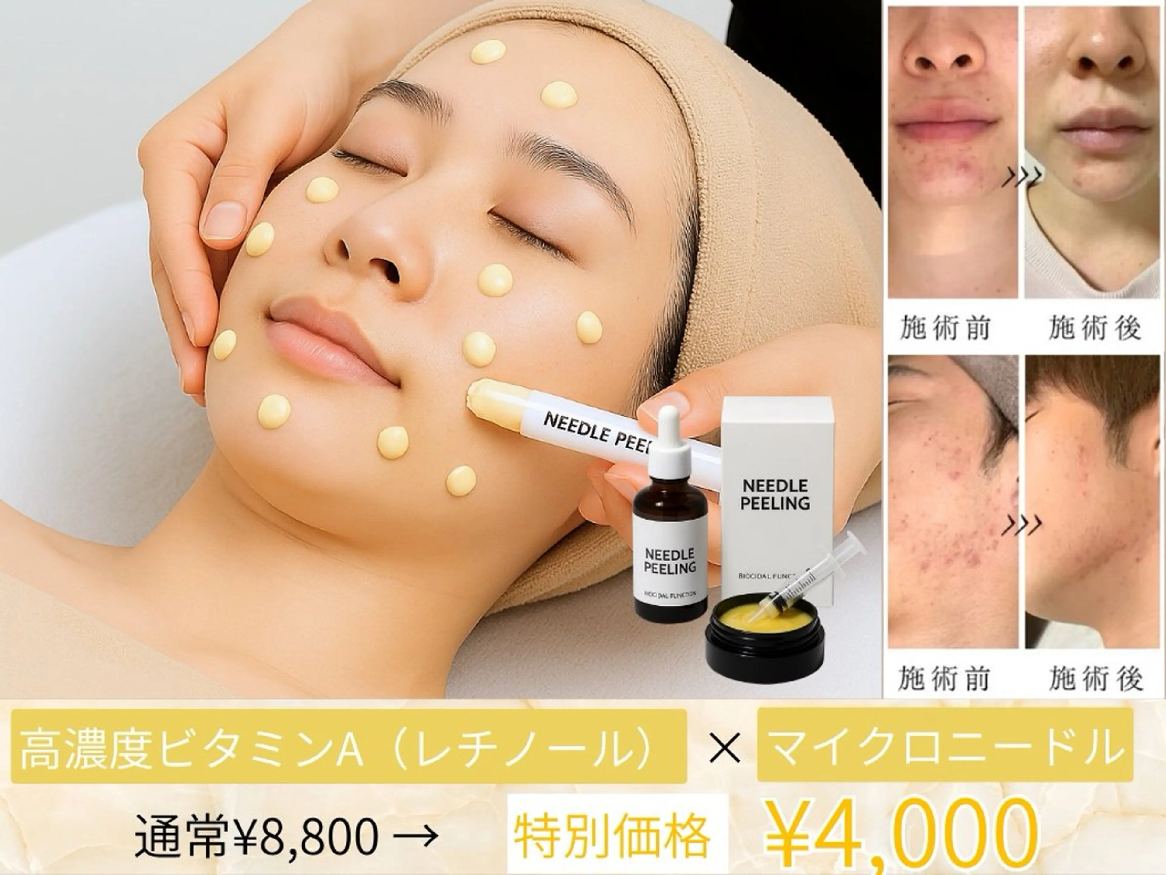 【30日31日限定❗即効性重視の方に◎】高濃度ビタミンA(レチノール)×ニードルで気になる肌悩みを排出!ニキビ/ニキビ跡の写真