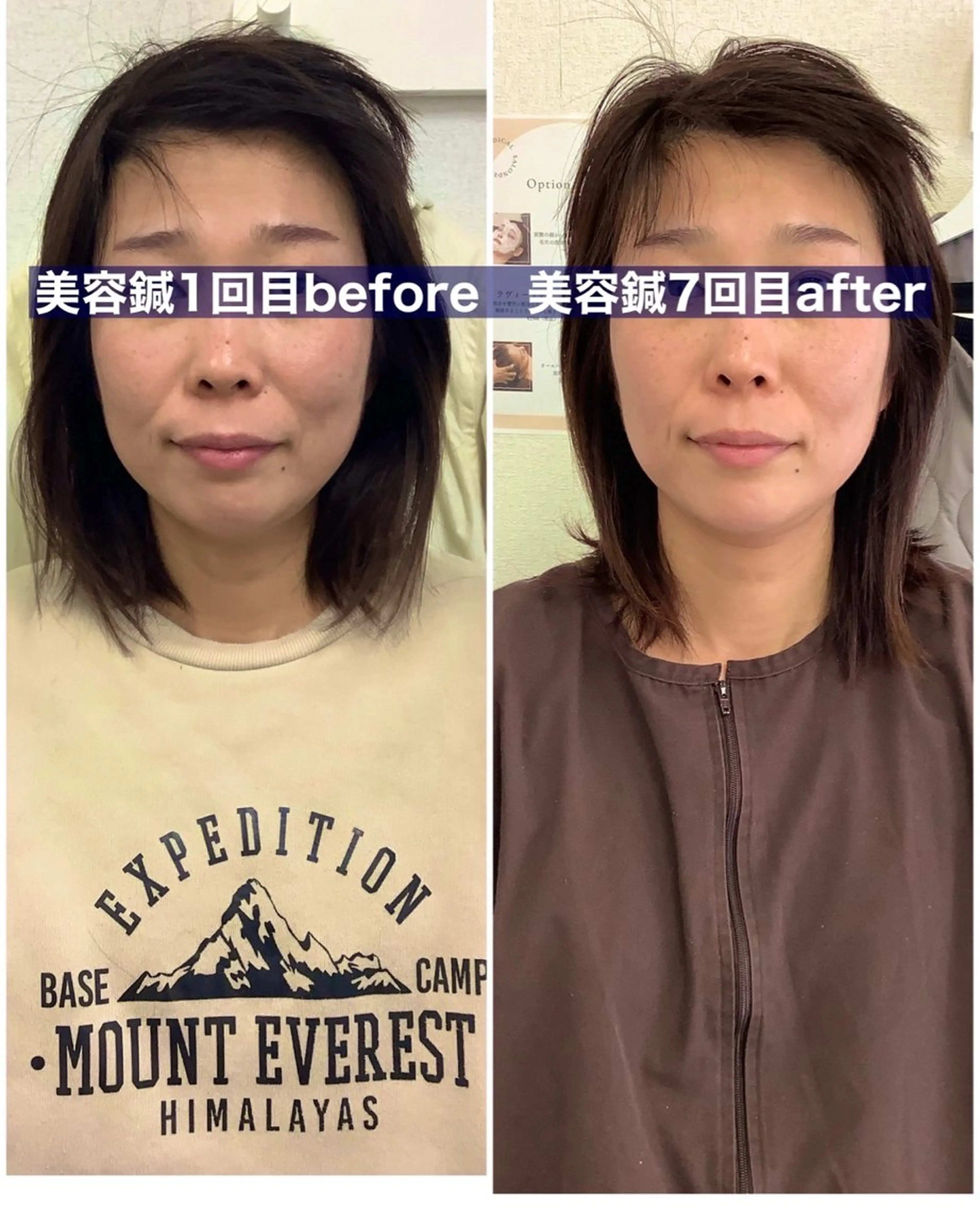 hari salon de off　美容鍼灸×小顔整体【ハリサロンドオフ】所属・美容鍼×小顔整体🤍 ishibashiのエステ・リラクイメージ