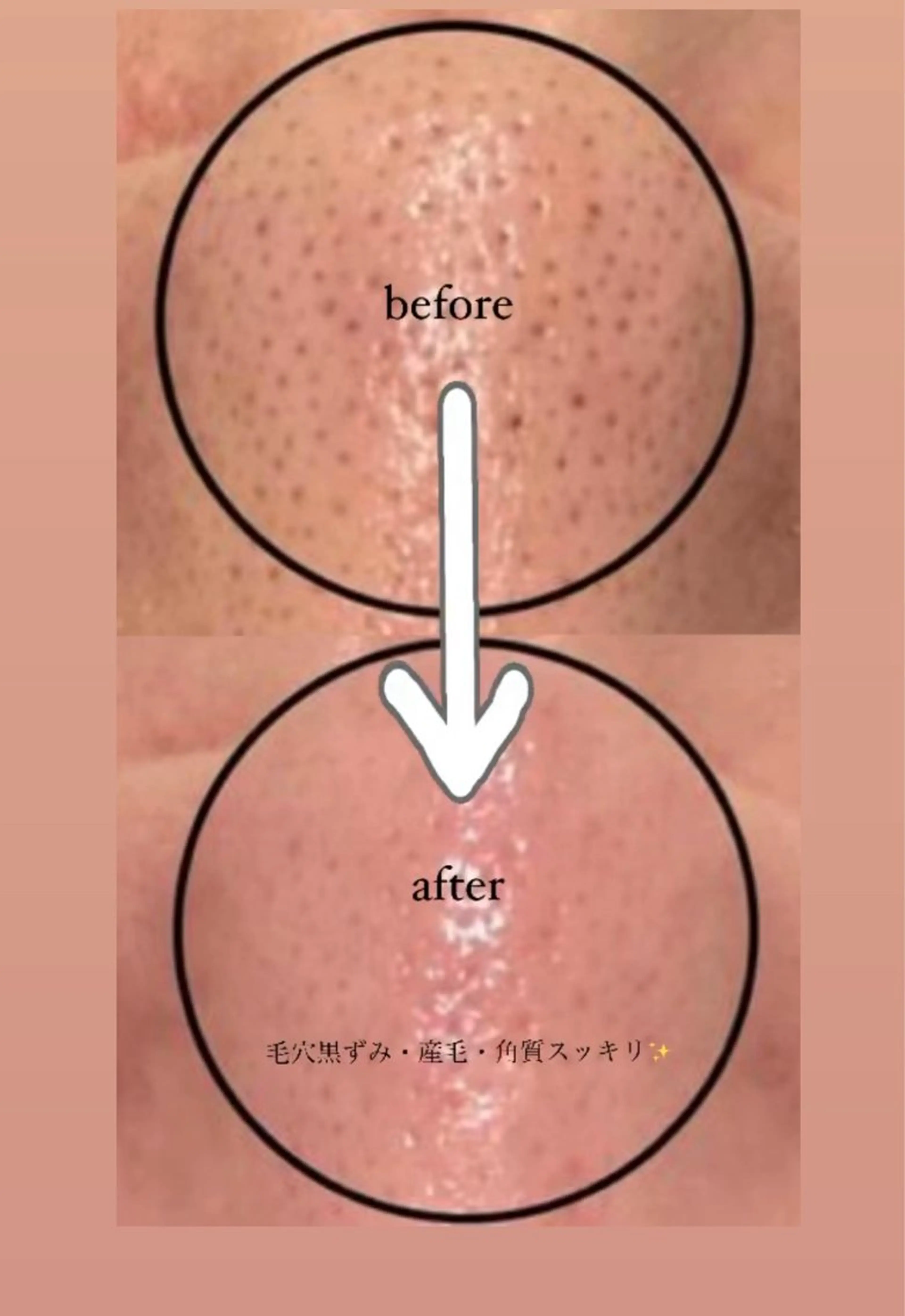 Min MinワックスフェイシャルWax脱毛で毛穴黒ずみ・産毛・角質・小鼻もスッキリ✨ 生コラーゲン美容液たっぷり導入の写真