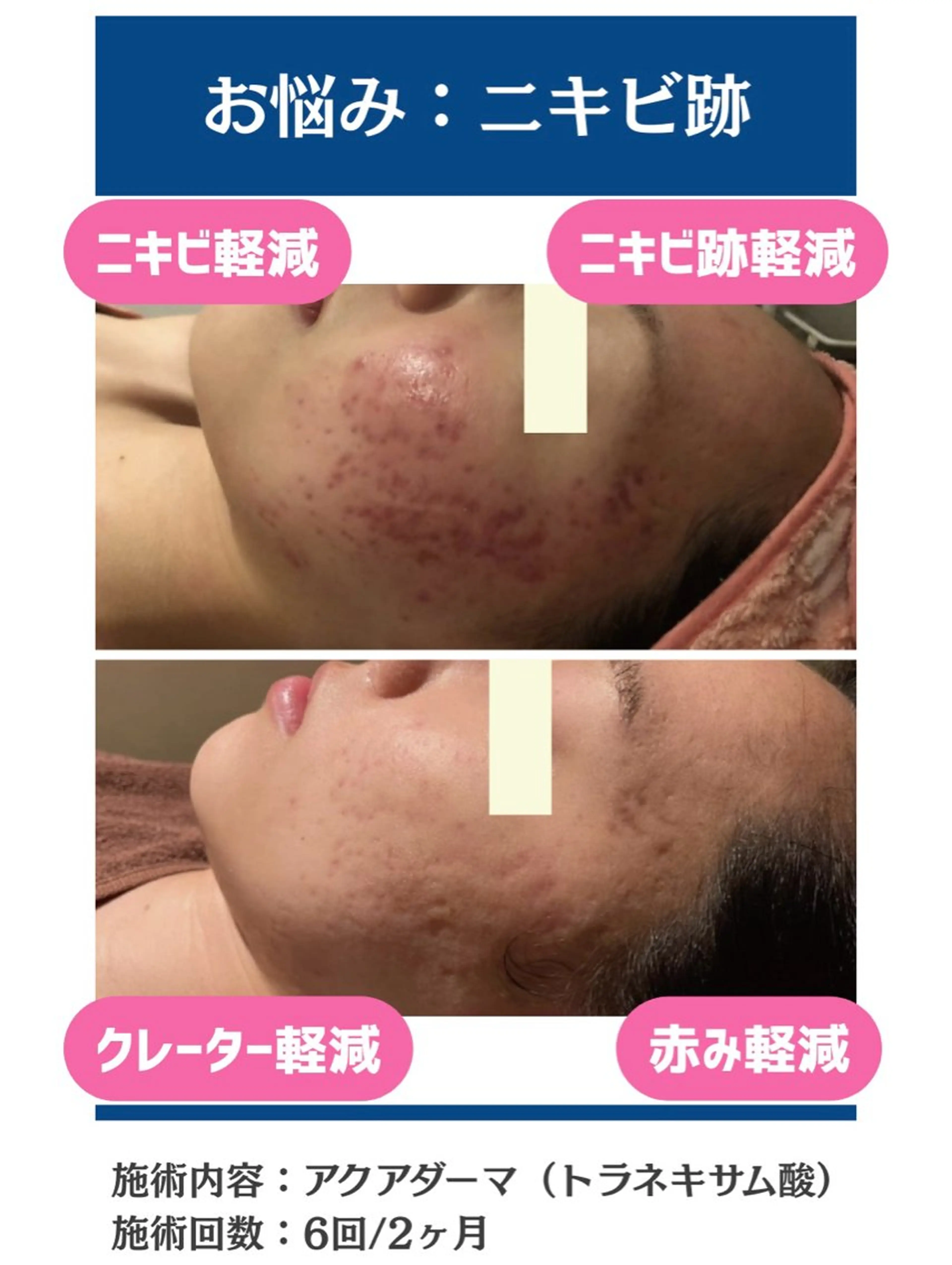 エステ 毛穴レス美肌へ🌿 看護師Abe🌼のエステ・リラクイメージ