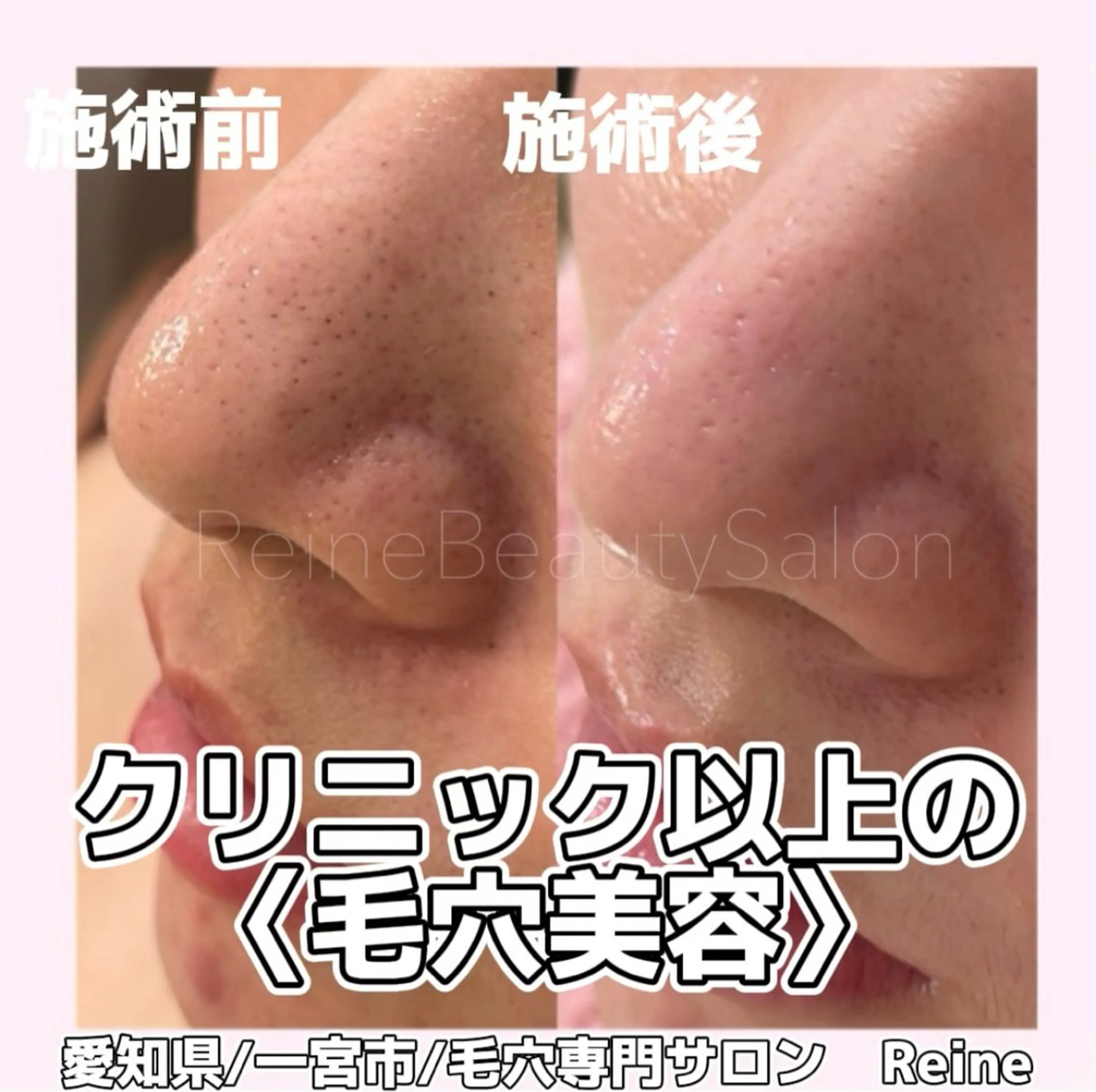 エステ Reine BeautySalon所属・毛穴/シミ肝斑/脱毛 横山梨里のエステ・リラクイメージ