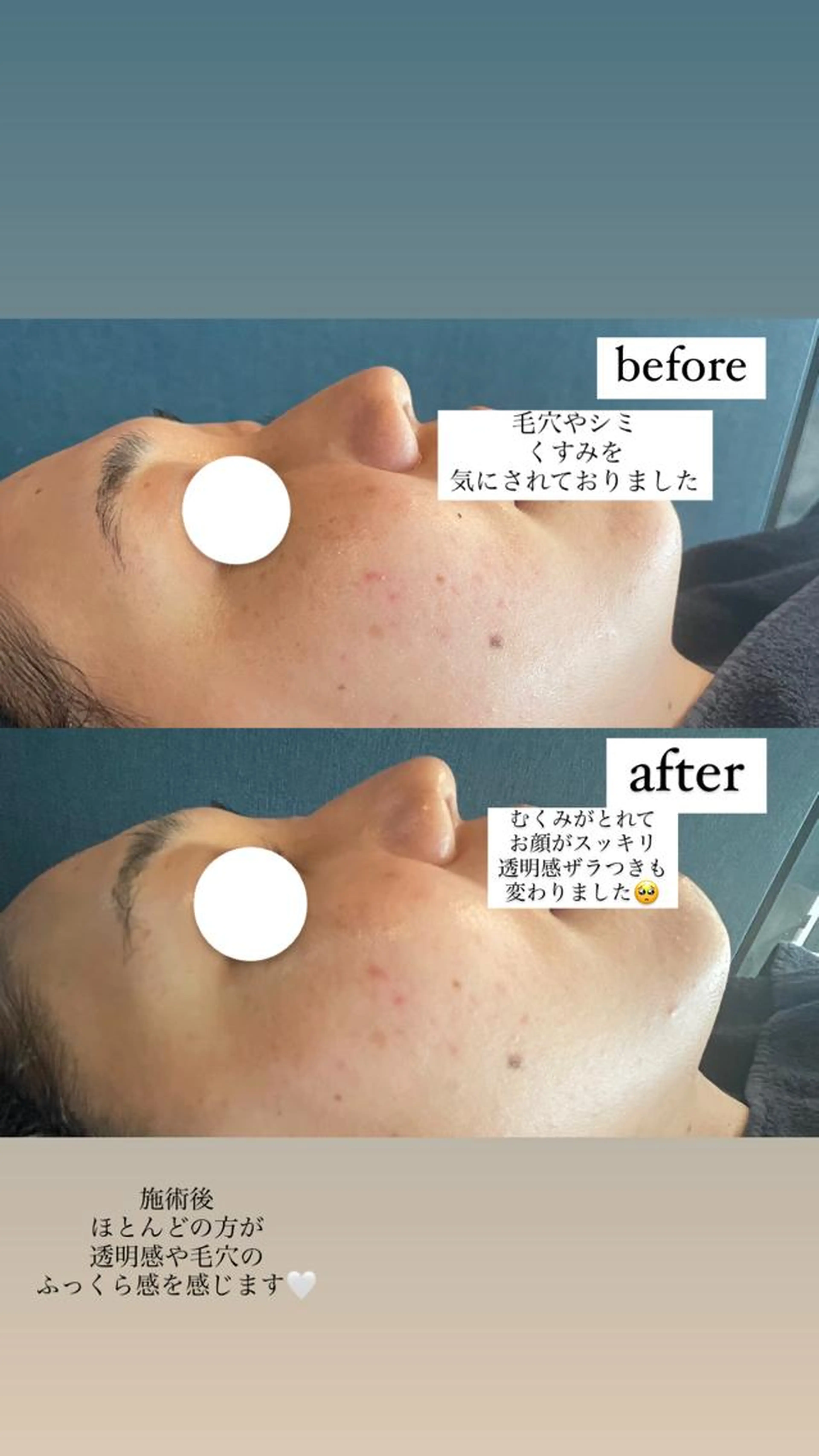 エステ初めての方でも安心【小顔リフトUPフェイシャル✨】フェイシャルオイルマッサージ＋数量限定ヒト幹細胞パック🤍の写真