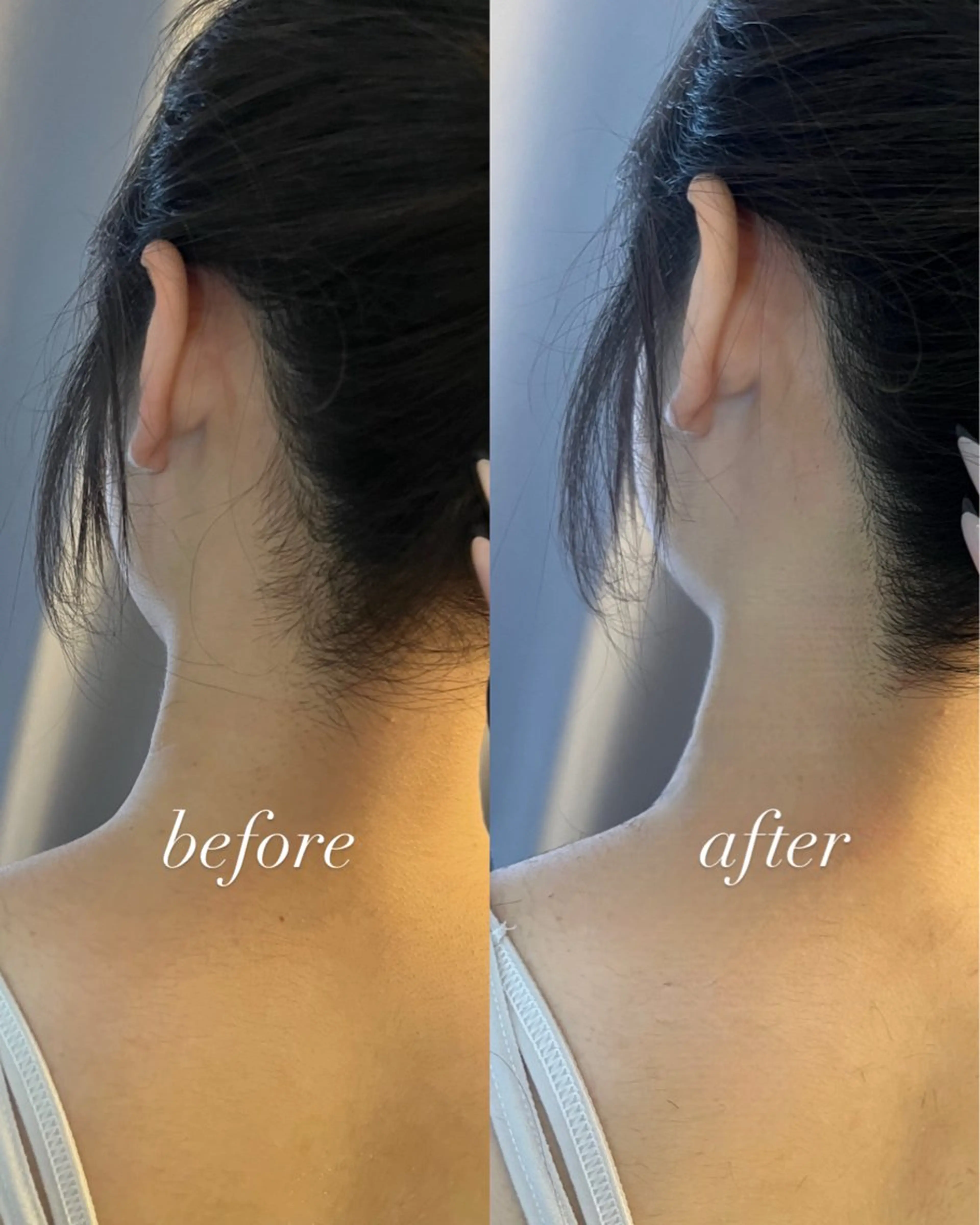 脱毛 うなじ脱毛/美肌脱毛 LABELのエステ・リラクイメージ