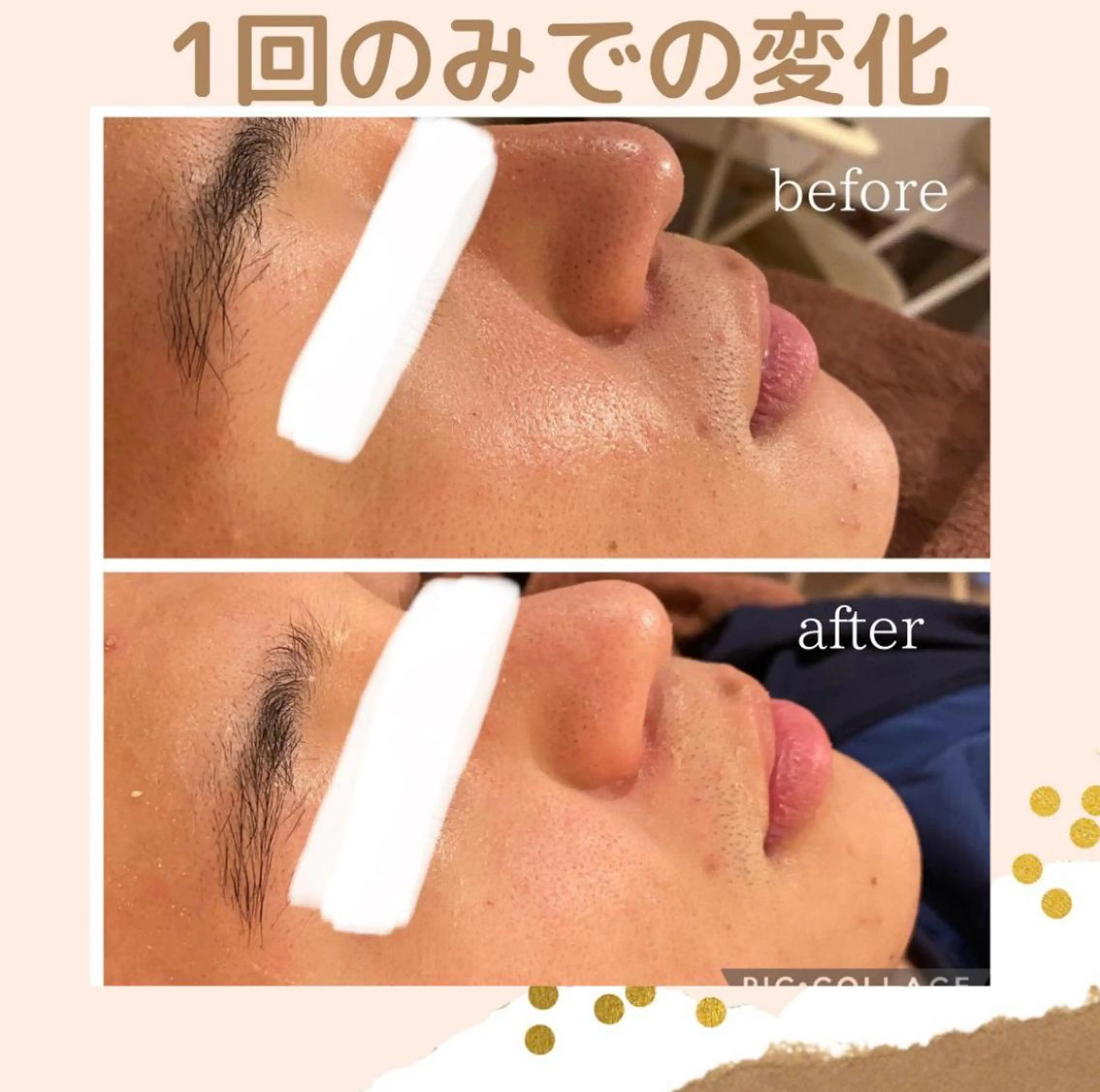 都内で出来る肌管理! 最短ニキビ改善のエステ・リラクイメージ