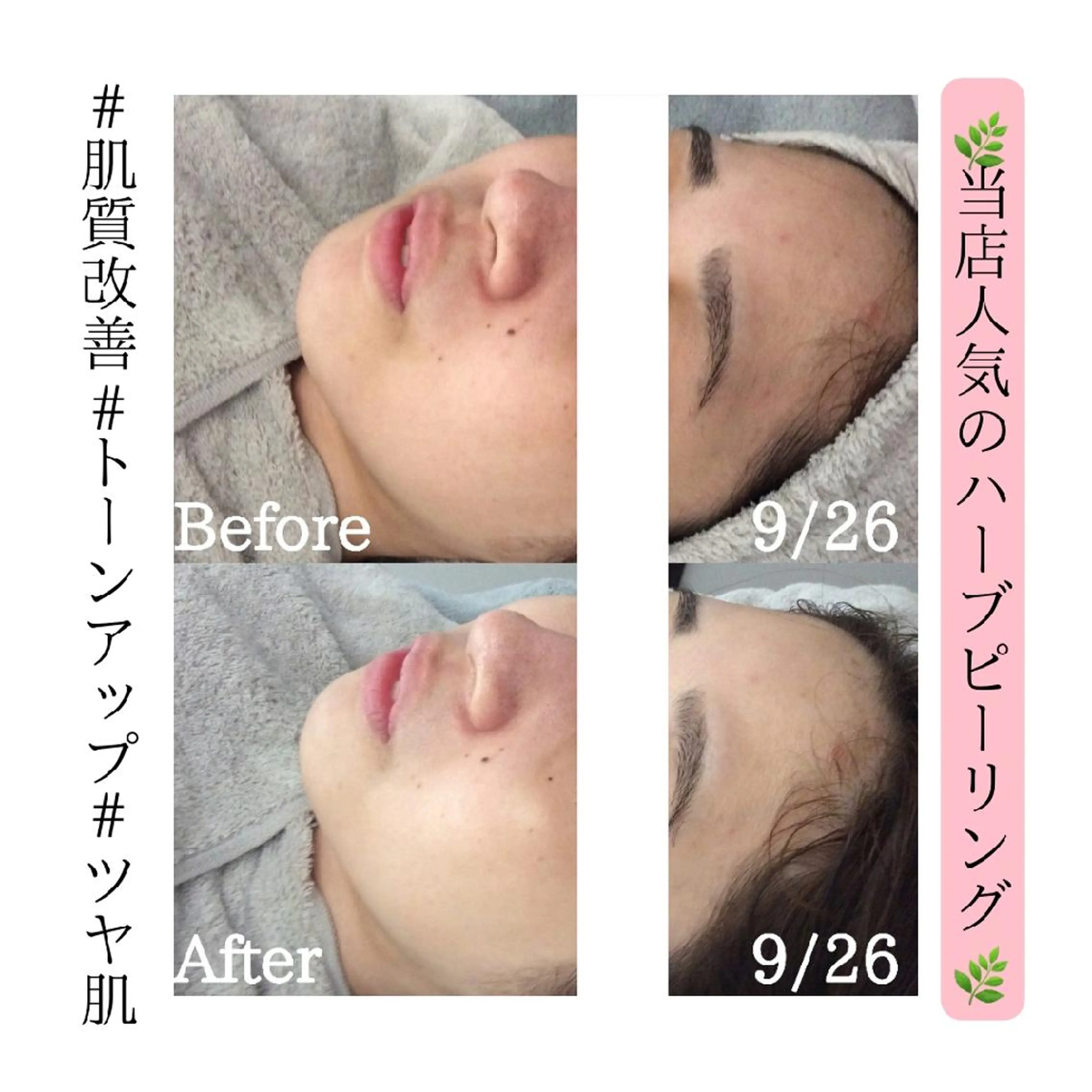 🌿《剥けないハーブピーリング》ダウンタイムなし！痛みなし！当日メイクOK！の写真