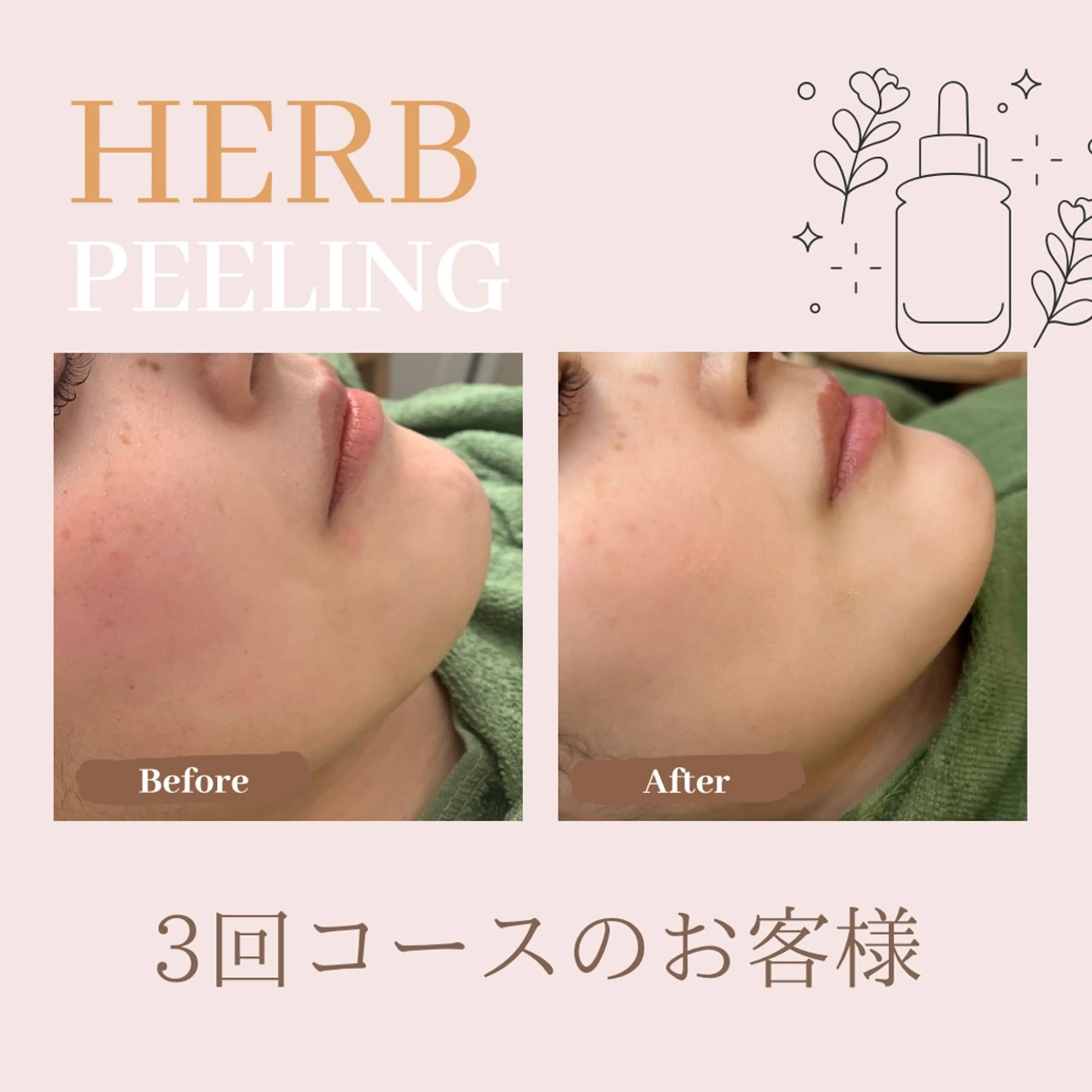 【大人気✨】ダウンタイムなし！育肌ハーブピーリング🌿ツヤ肌/トーンアップ✨の写真