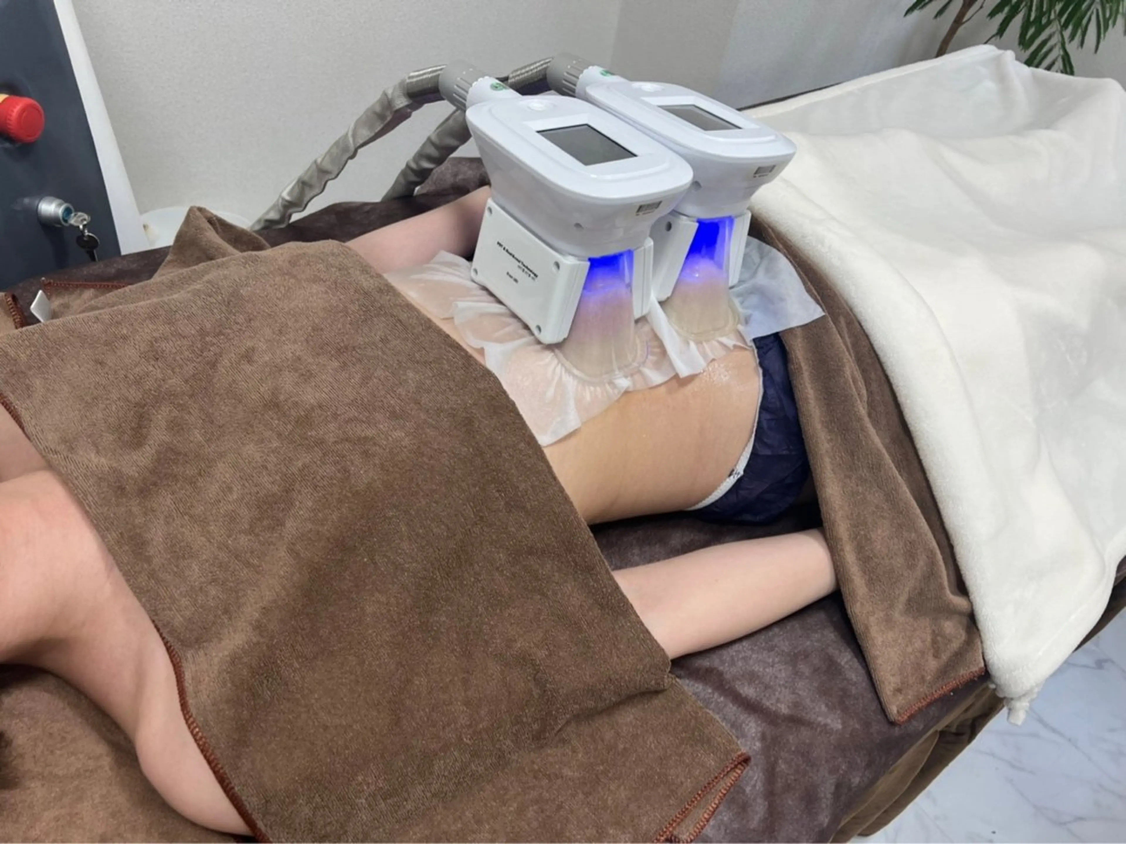 ミニモ限定価格🧊冷却痩身🧊【脂肪はトイレに流す時代】一度で最大20%の脂肪細胞排出を促します🔥※1日1名様の写真